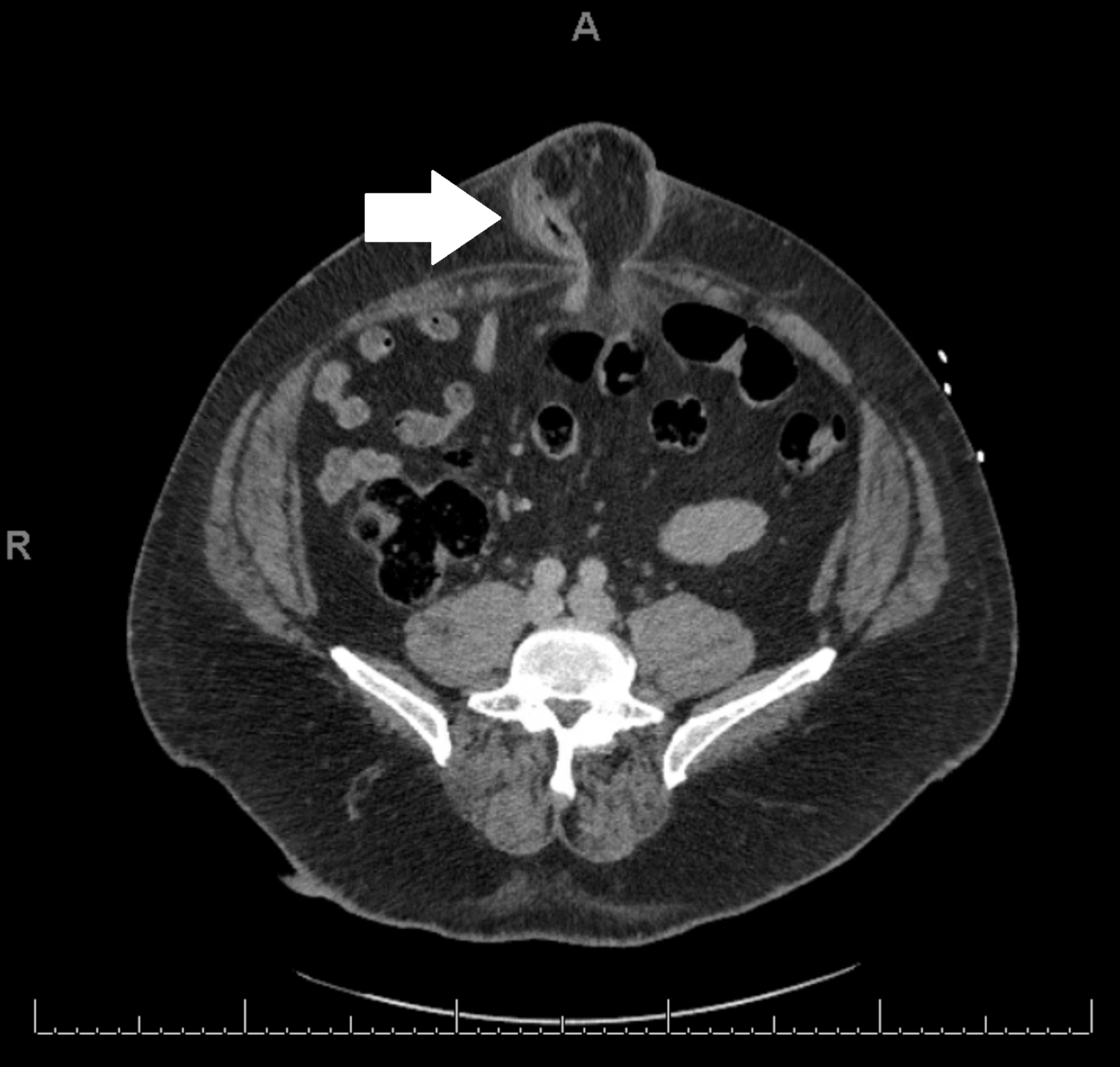 Cureus Umbilical Hernia Containing Appendicitis