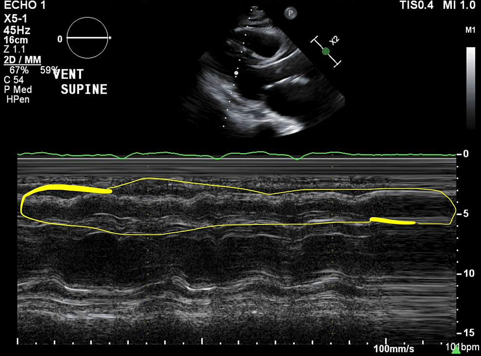 TTE-image-(parasternal-long-axis-view)