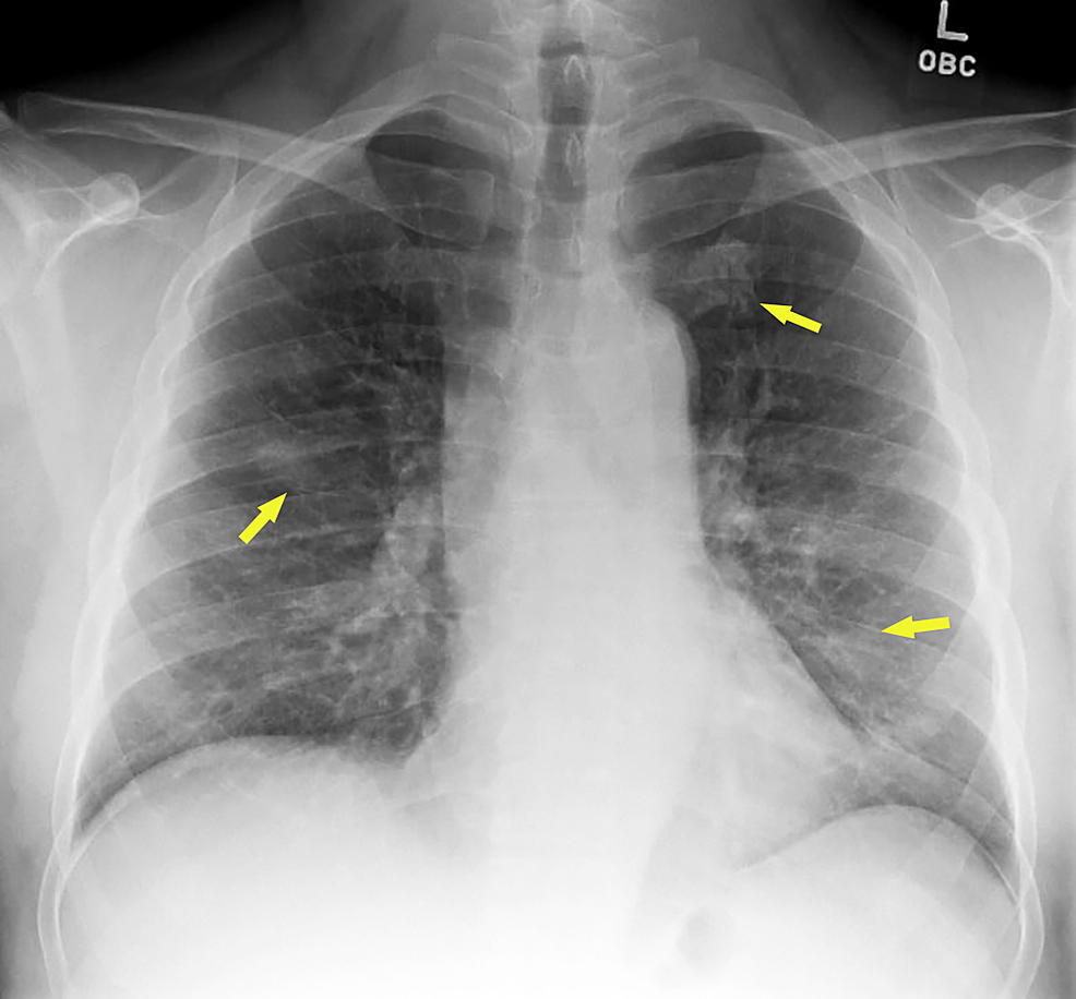 viral pneumonia chest x ray findings