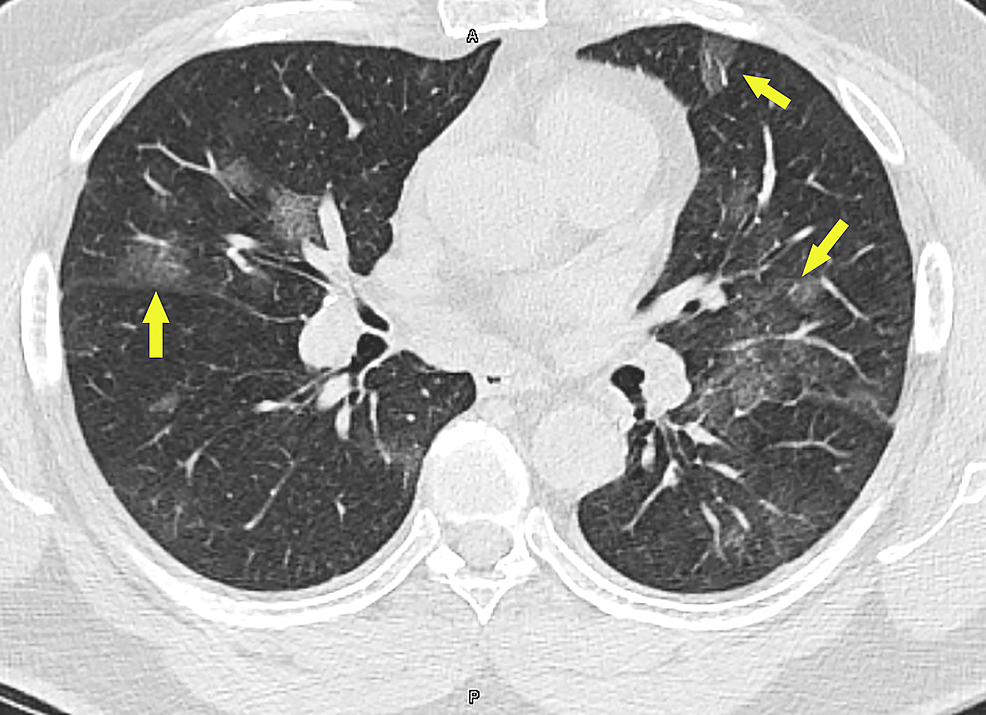 CT-scan-of-the-thorax-showing-multifocal-bilateral-ground-glass-lung-opacities-with-areas-of-subpleural-sparing-(arrows)