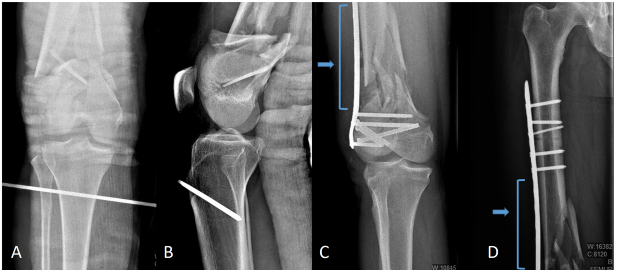 Cureus | Treatment Of Periarticular Fractures Of The Knee Using The ...