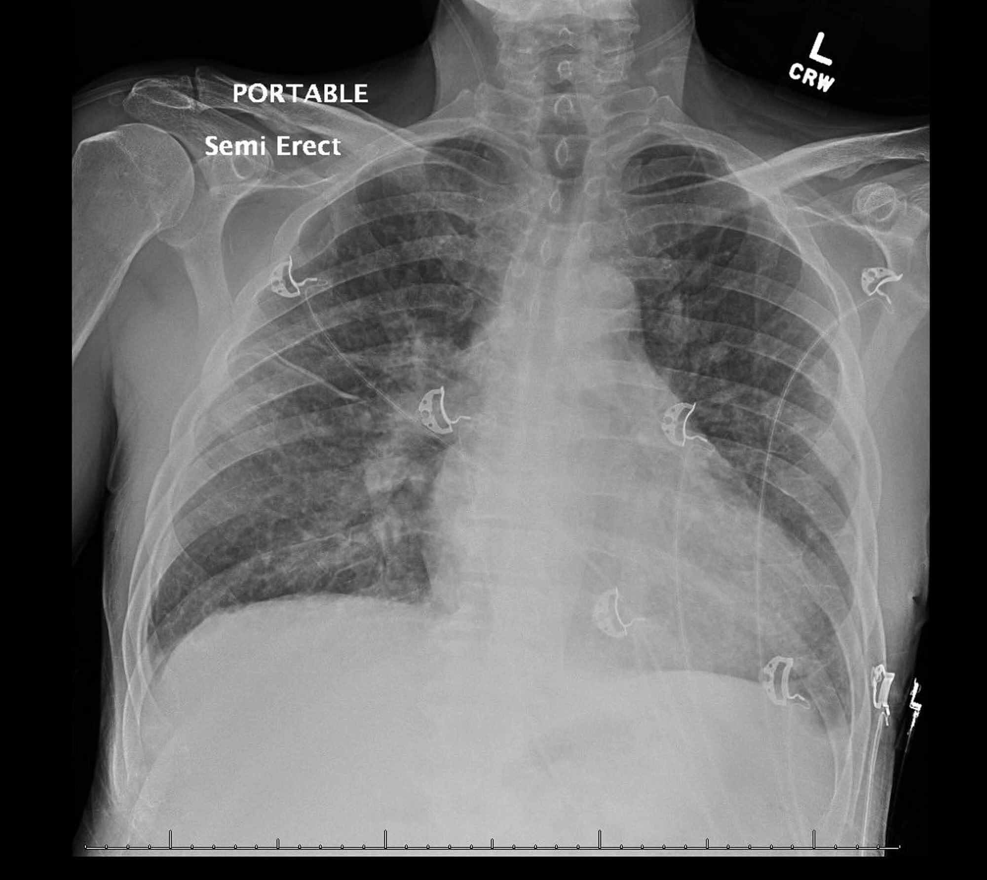 Cureus | When Zoonotic Organisms Cross Over—Trueperella pyogenes ...