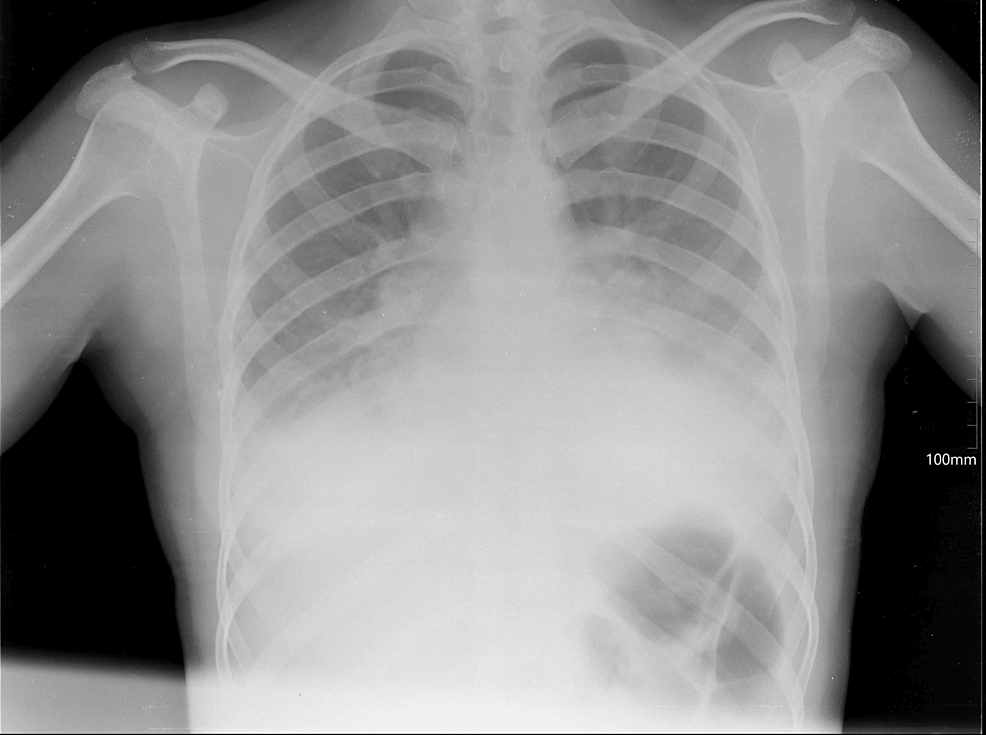 Patient's-pleural-effusion-and-extensive-consolidation