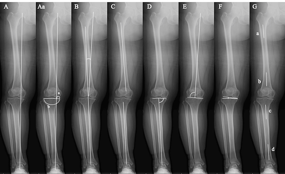 A Morphological Study of Distal Femoral Varus Deformity Cureus