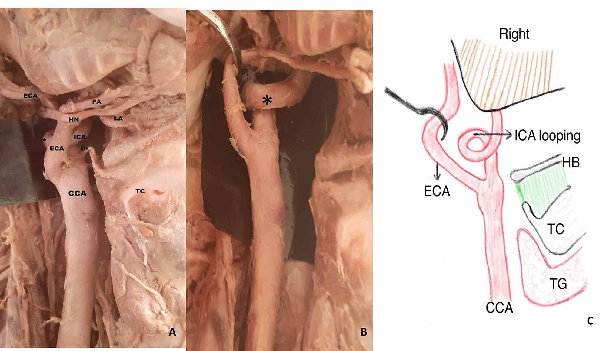 Cureus A Cadaveric Study On The Course Of The Cervical Segment Of The Internal Carotid Artery And Its Variations