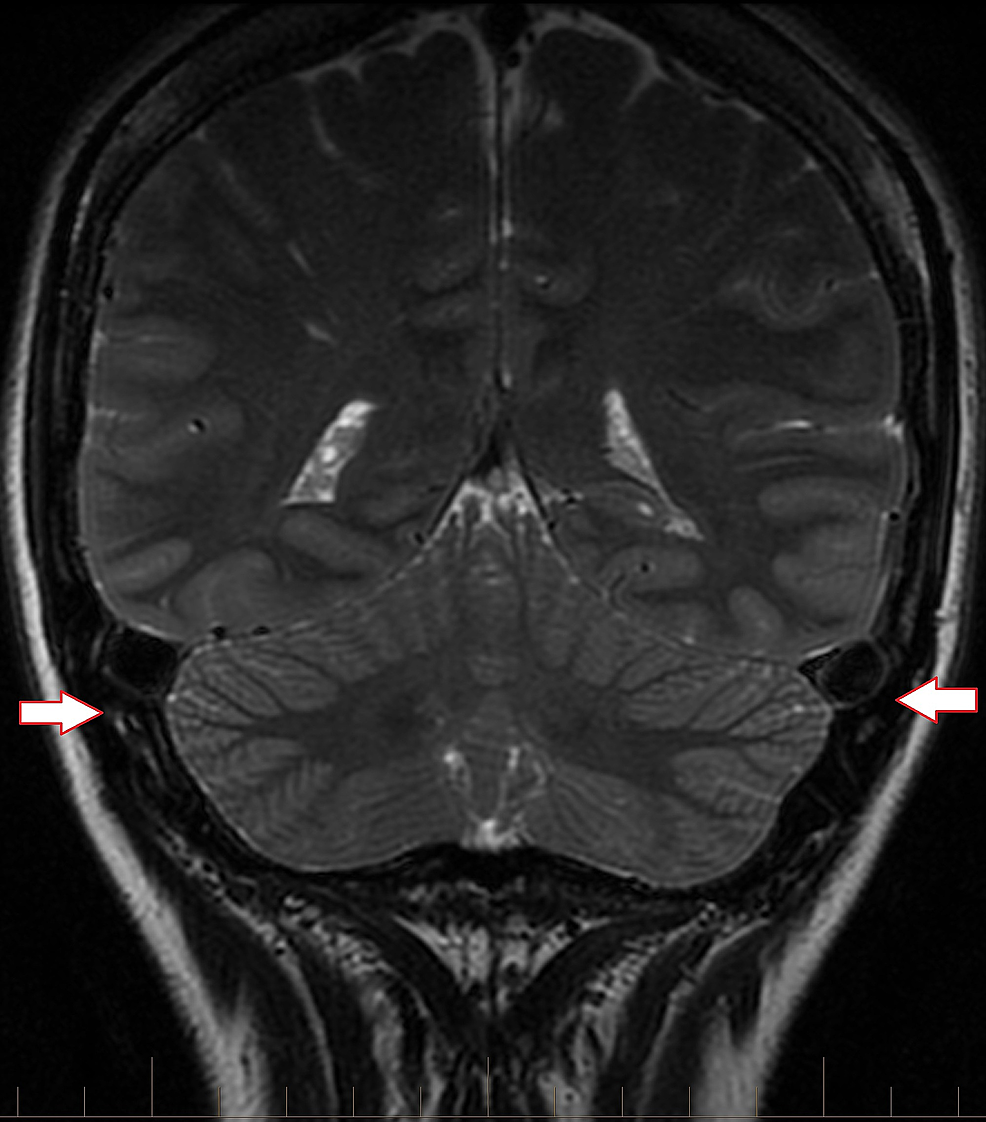Coronal-T2-brain-MRI-revealing-an-engorged-appearance-of-the-bilateral-transverse-dural-venous-sinuses