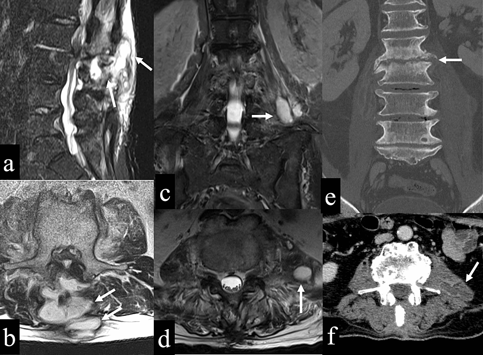 Cureus A Case of Significant Coagulopathy Due to Vitamin K Deficiency