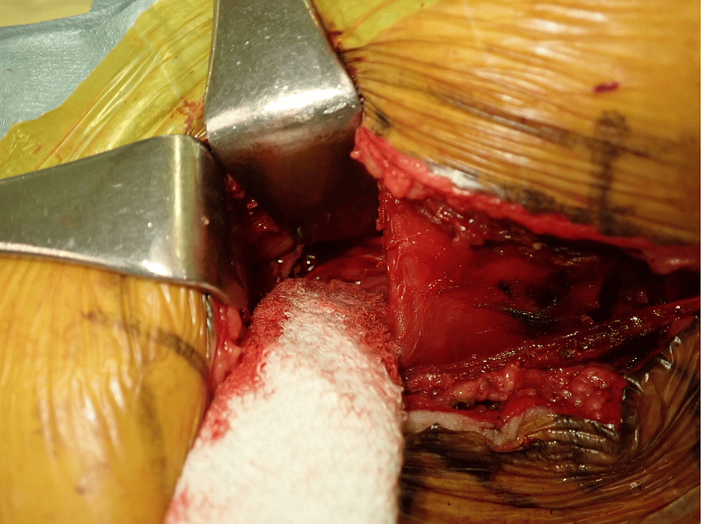 Cureus A Case of Significant Coagulopathy Due to Vitamin K Deficiency