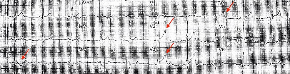 Initial-EKG-from-the-ambulance-showing-anterolateral-2mm-ST-elevations-(arrows).