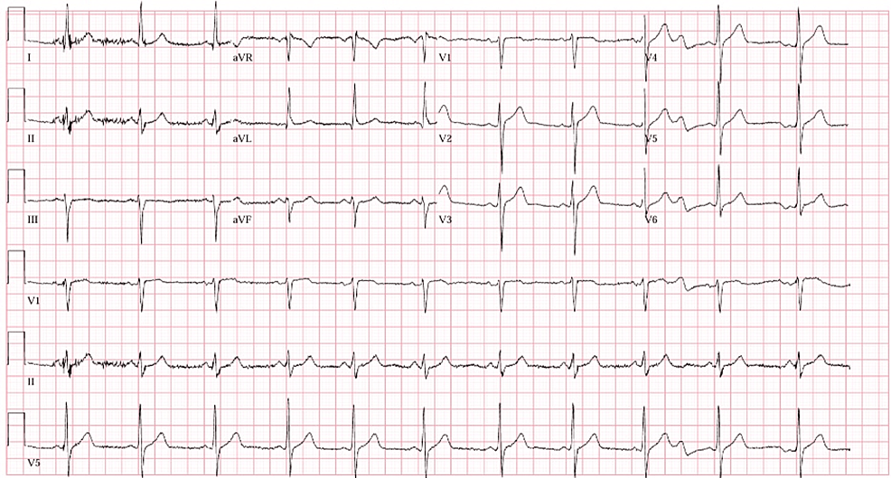 EKG-in-the-ED-after-administration-of-sublingual-nitroglycerin-showing-resolution-of-the-ST-segments-elevations-in-lead-V2-V4-that-were-previously-seen-on-prior-EKG.