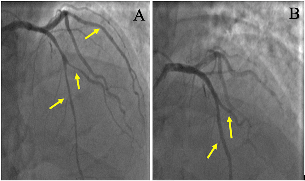 Coronary-angiography-showing-diffuse-coronary-vasospasms-in-left-anterior-descending-and-left-circumflex-(arrows)-before-(A)-and-after-(B)-intra-coronary-nitroglycerin-administration.-