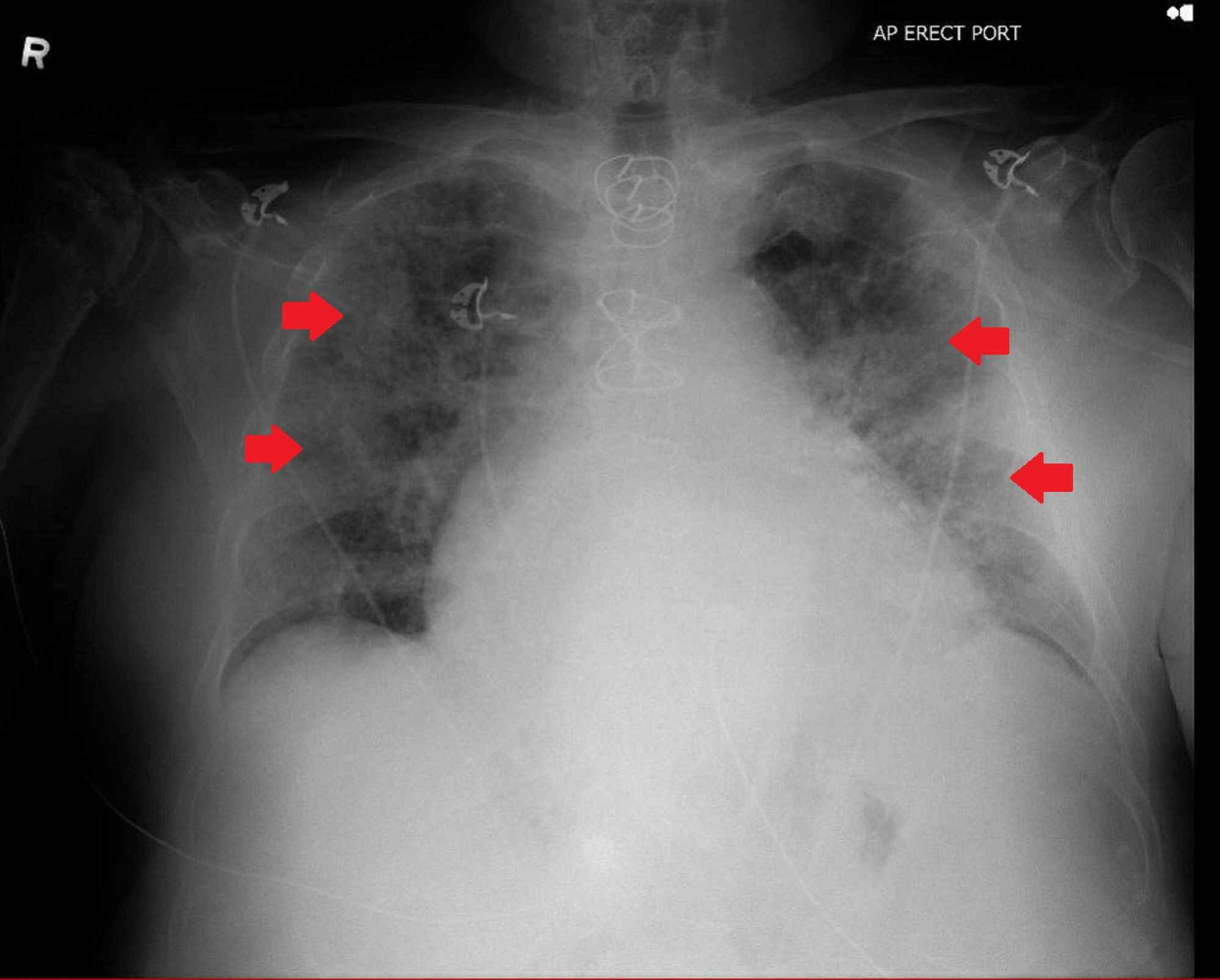 Download Cureus Coronavirus Disease 2019 Covid 19 Complicated By Acute Respiratory Distress Syndrome An Internist S Perspective