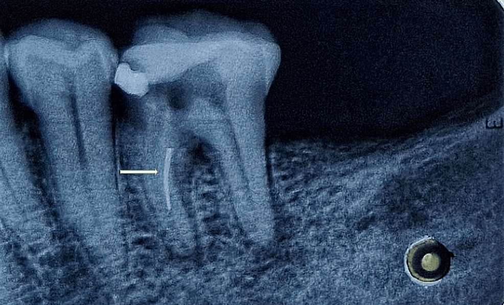 Management of an Intracanal Separated Instrument in the Lower