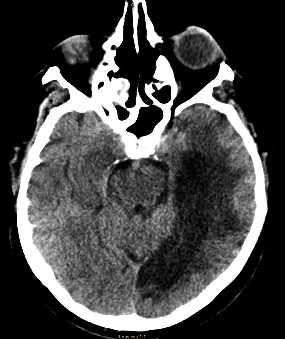 CT-scan-of-the-head-that-shows-no-acute-changes.-There-is-an-area-of-hypodensity-in-the-right-temporal-region,-consistent-with-patient-know-prior-history-of-left-PCA-embolic-stroke