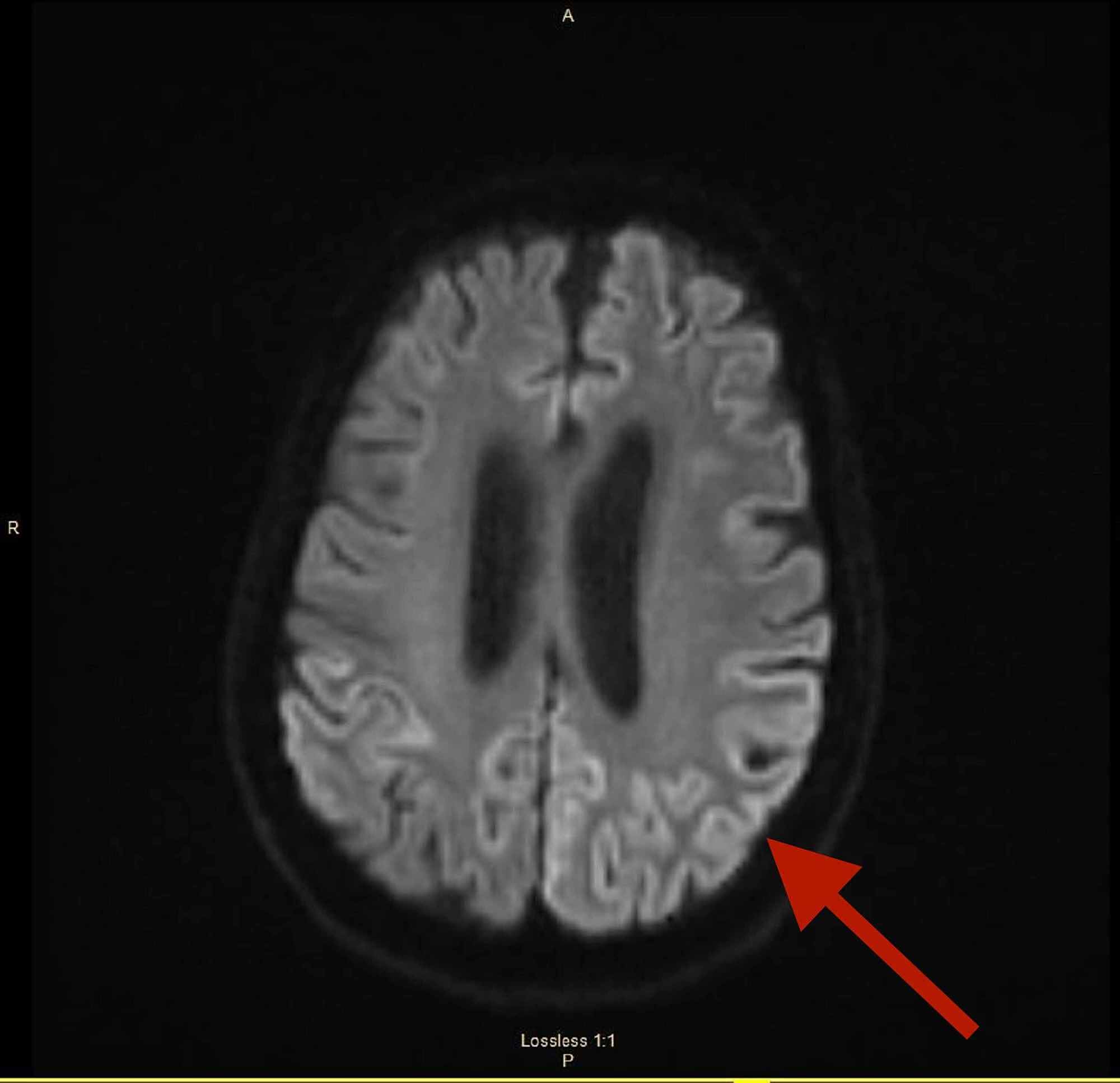 Cureus Sporadic CreutzfeldtJakob Disease Case Report and Literature