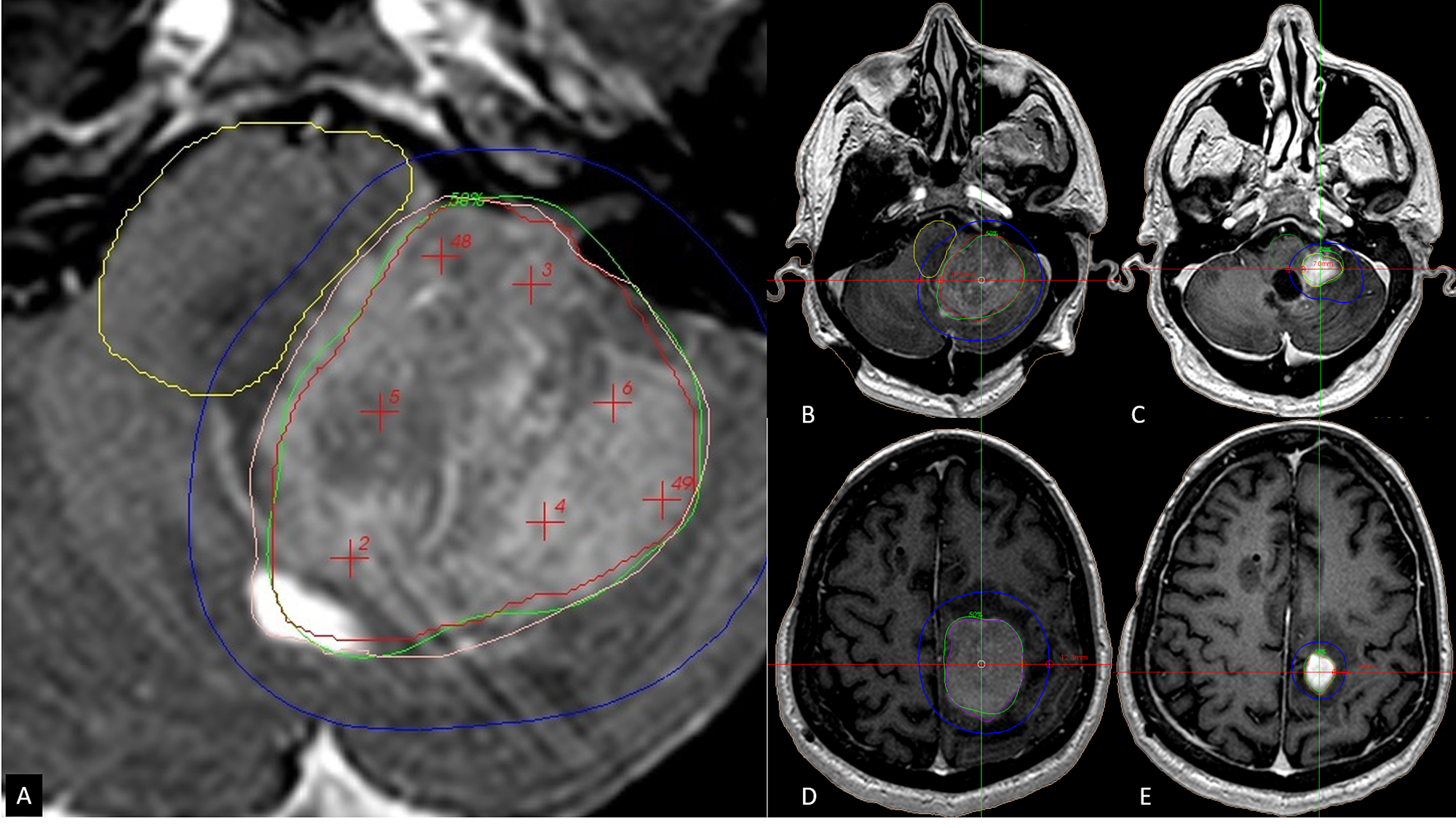 Cureus TwoSession Radiosurgery for Large Primary Tumors Affecting
