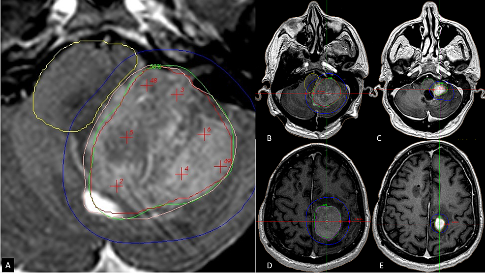Cureus TwoSession Radiosurgery for Large Primary Tumors Affecting