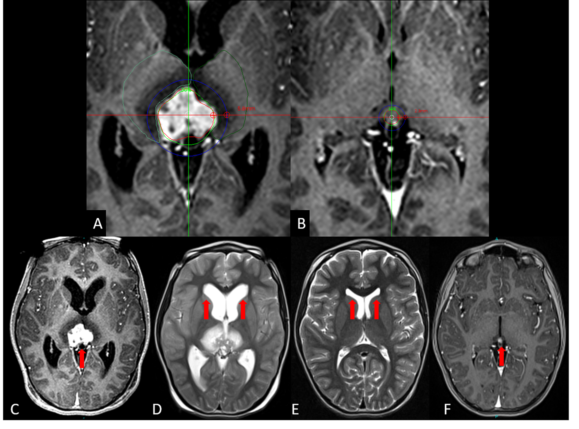 Cureus TwoSession Radiosurgery for Large Primary Tumors Affecting