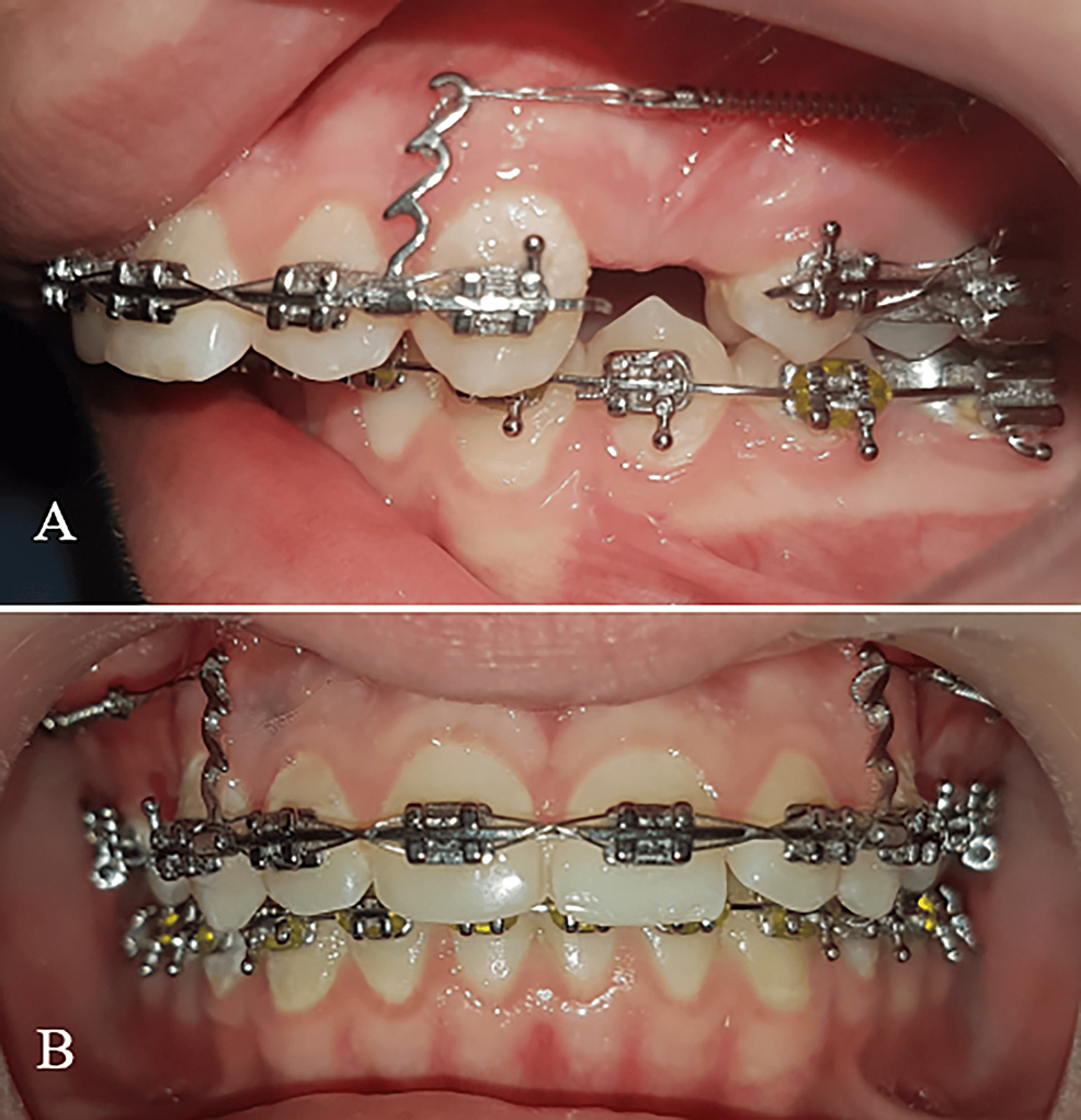 Cureus An Evaluation of the Rate and Type of Orthodontic Tooth