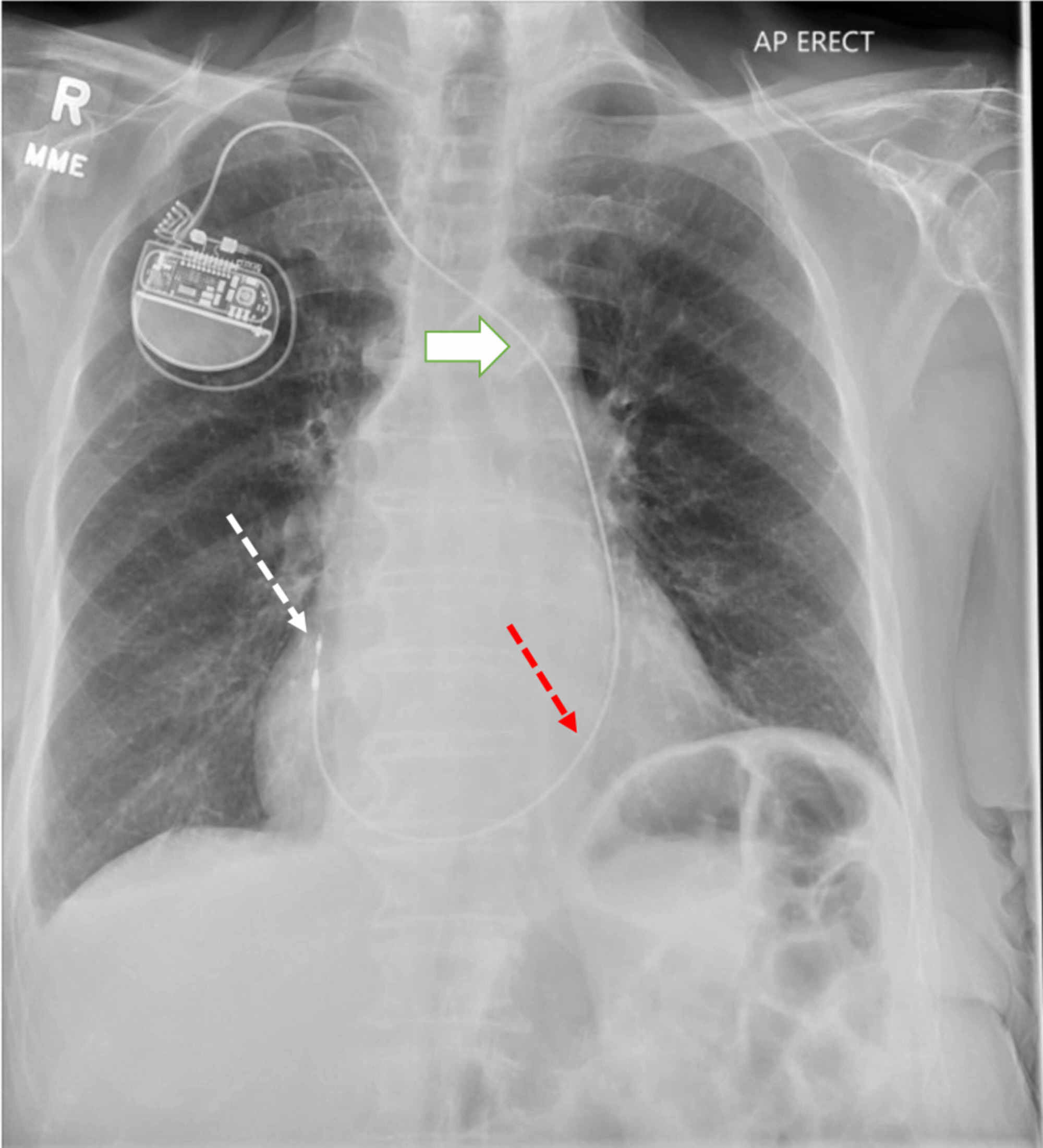 Cureus | Pacemaker Implantation in Patient With Persistent Left ...