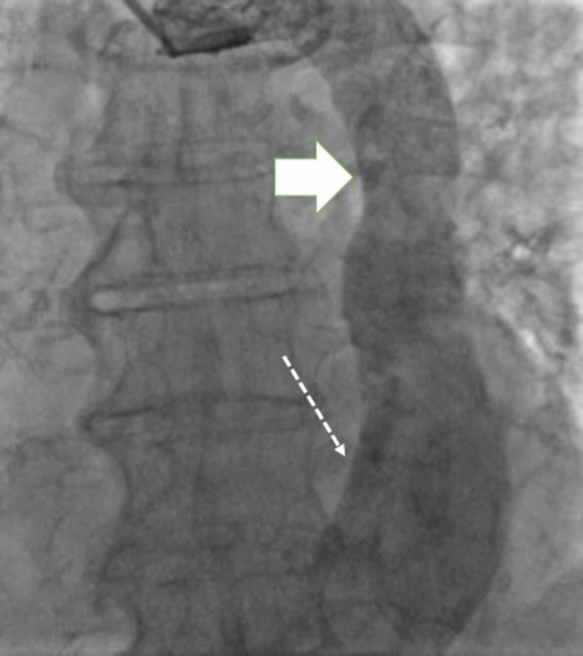 Cureus | Pacemaker Implantation in Patient With Persistent Left Superior  Vena Cava and Absent Right Superior Vena Cava