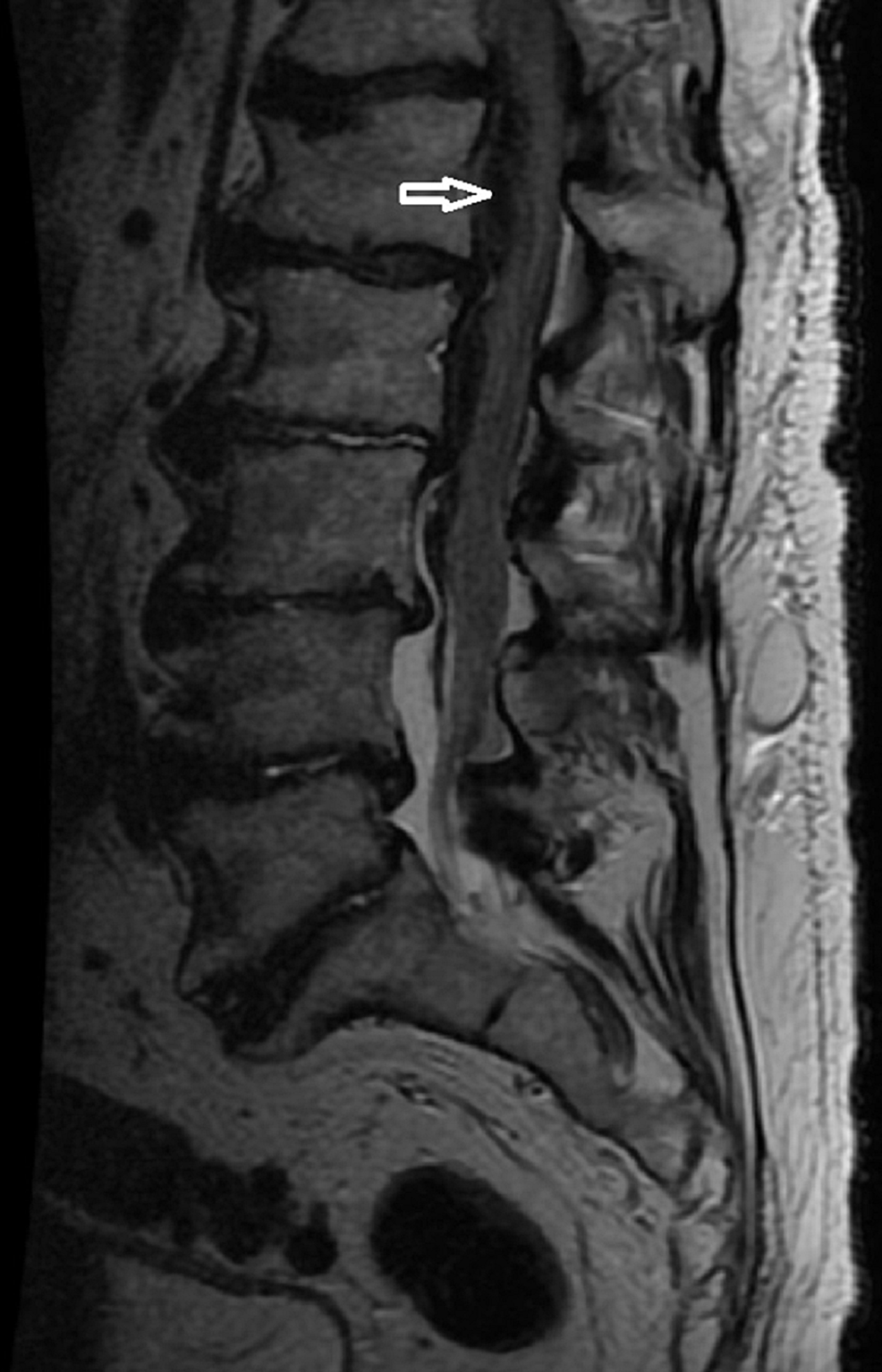 Cureus | Subdural Thoracolumbar Spine Hematoma after Spinal Anesthesia ...