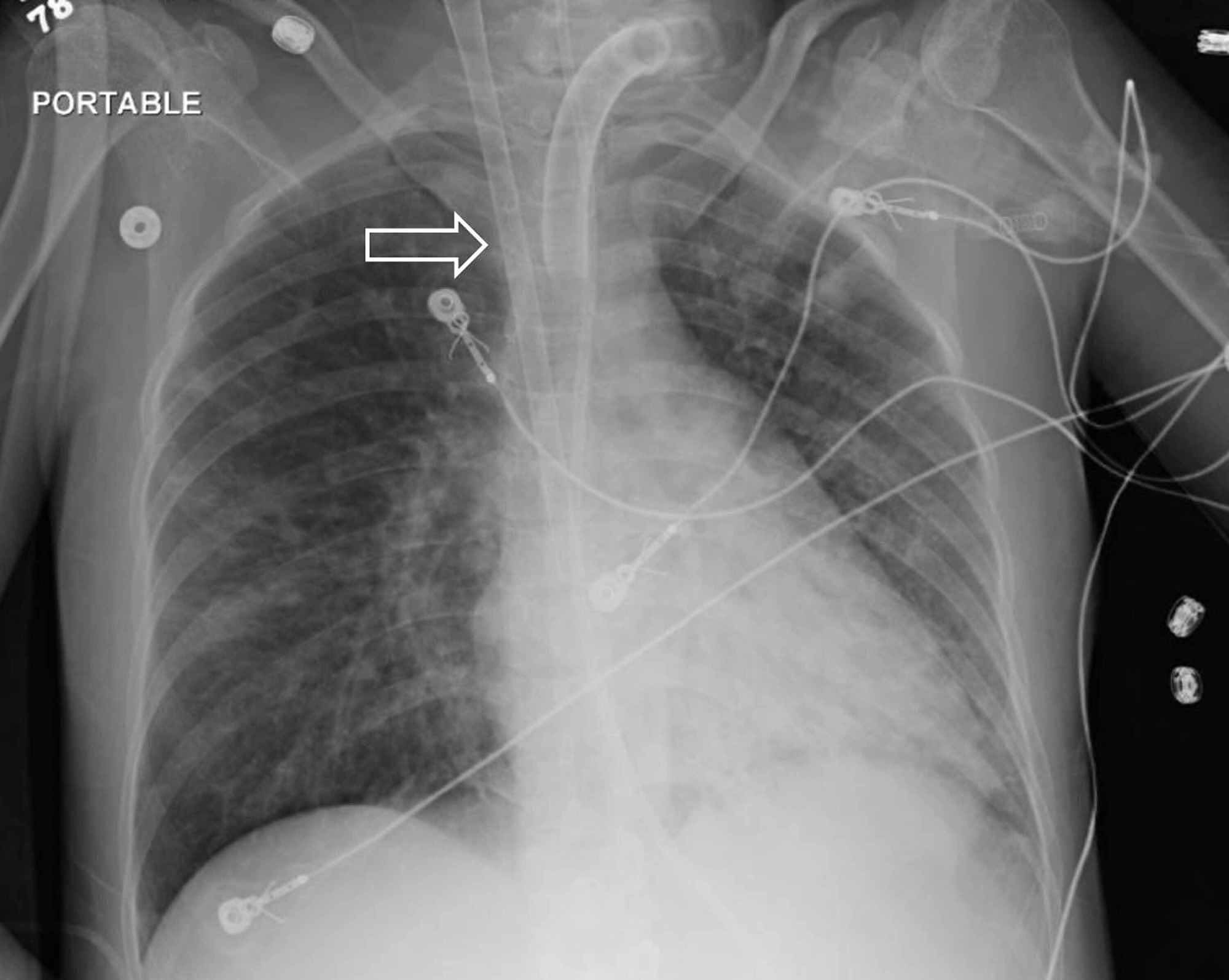 Cureus | Disseminated Gestational Trophoblastic Disease and Diffuse ...