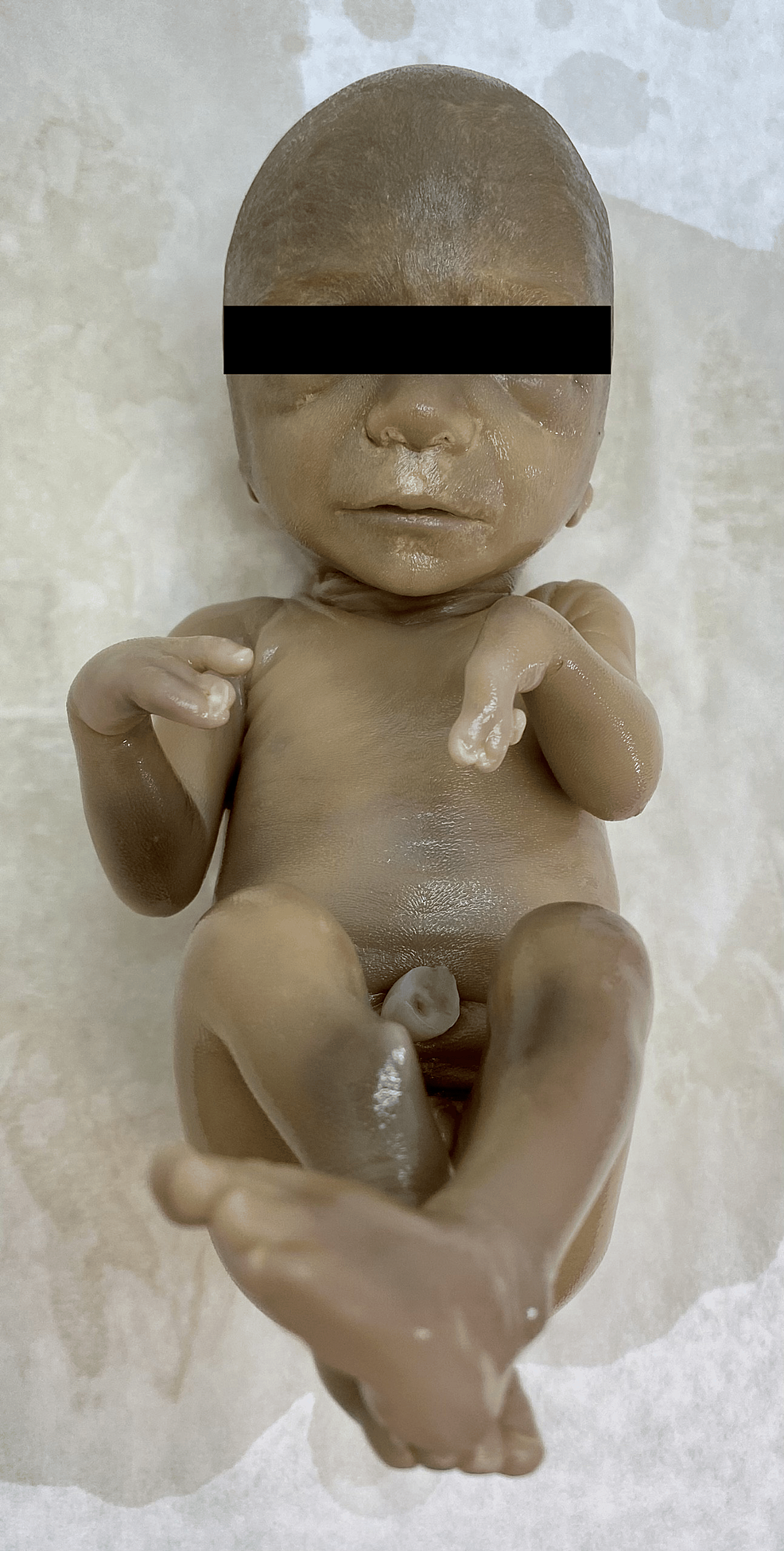 Foot Oligodactyly as the Main Dysplasia in Children | Cureus, image size:986x1949