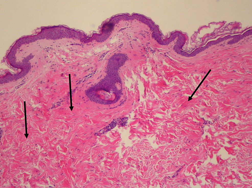 cureus-white-fibrous-papulosis-of-the-axillae-and-neck