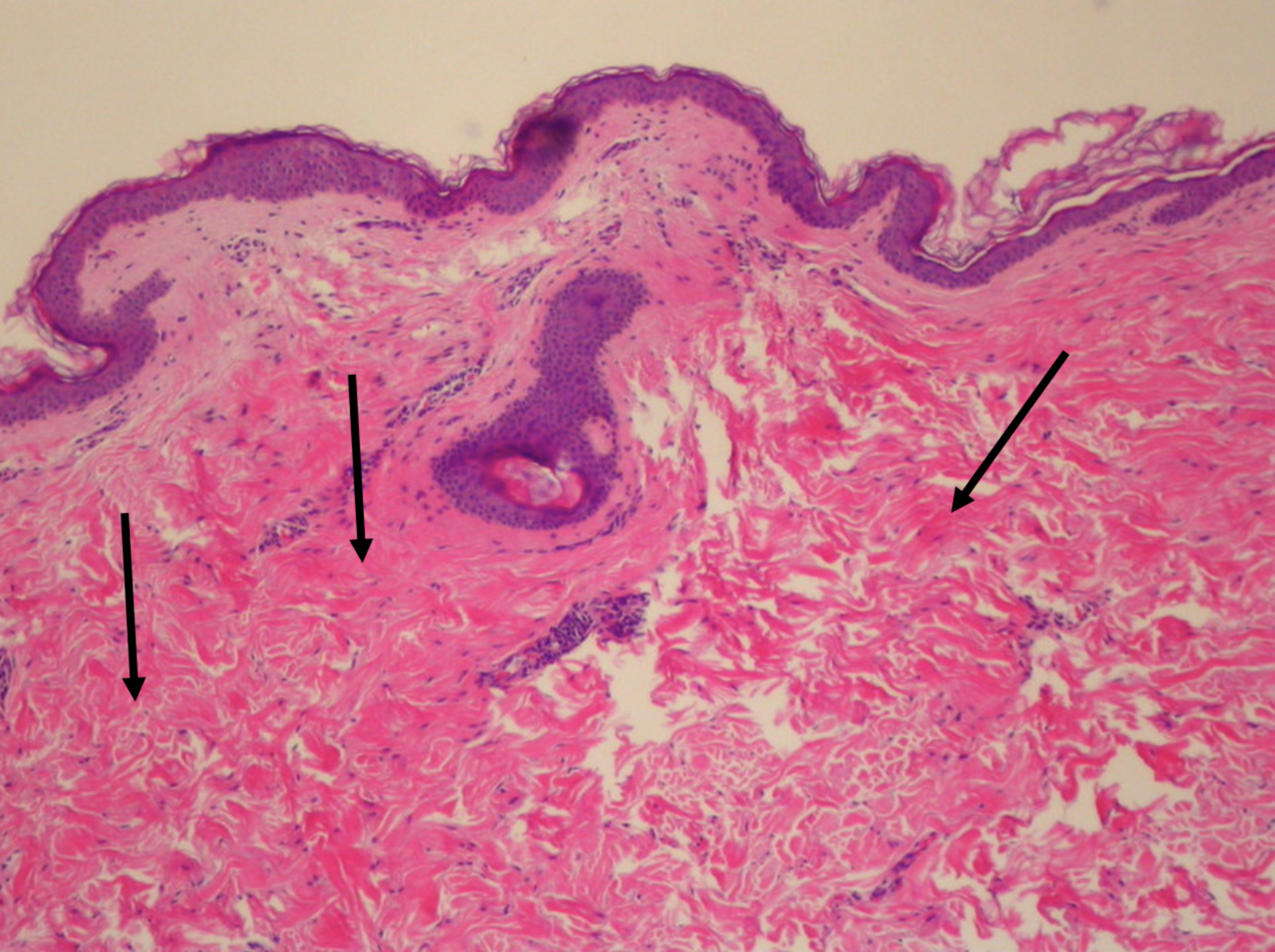 Cureus | White Fibrous Papulosis of the Axillae and Neck