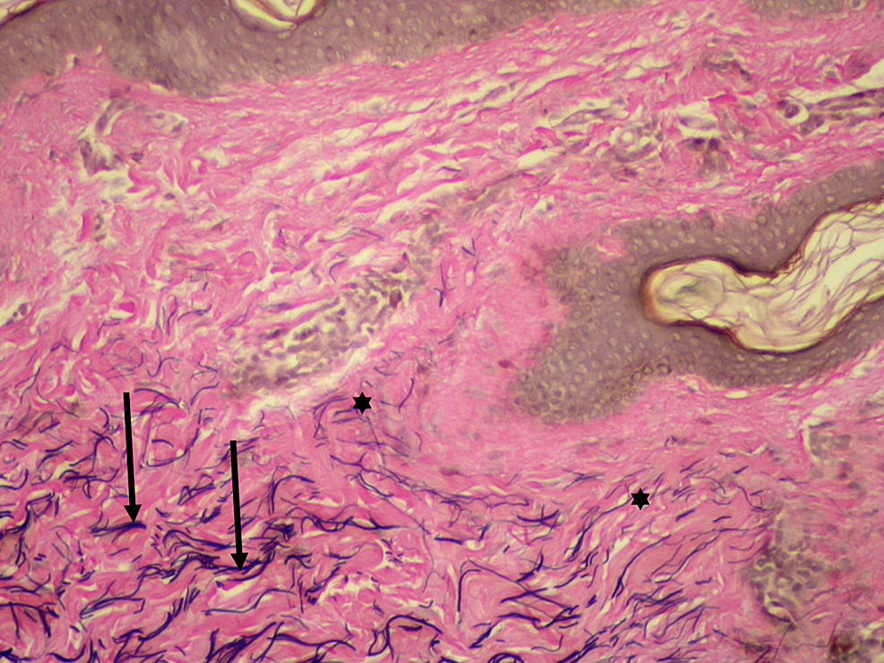 Cureus | White Fibrous Papulosis of the Axillae and Neck