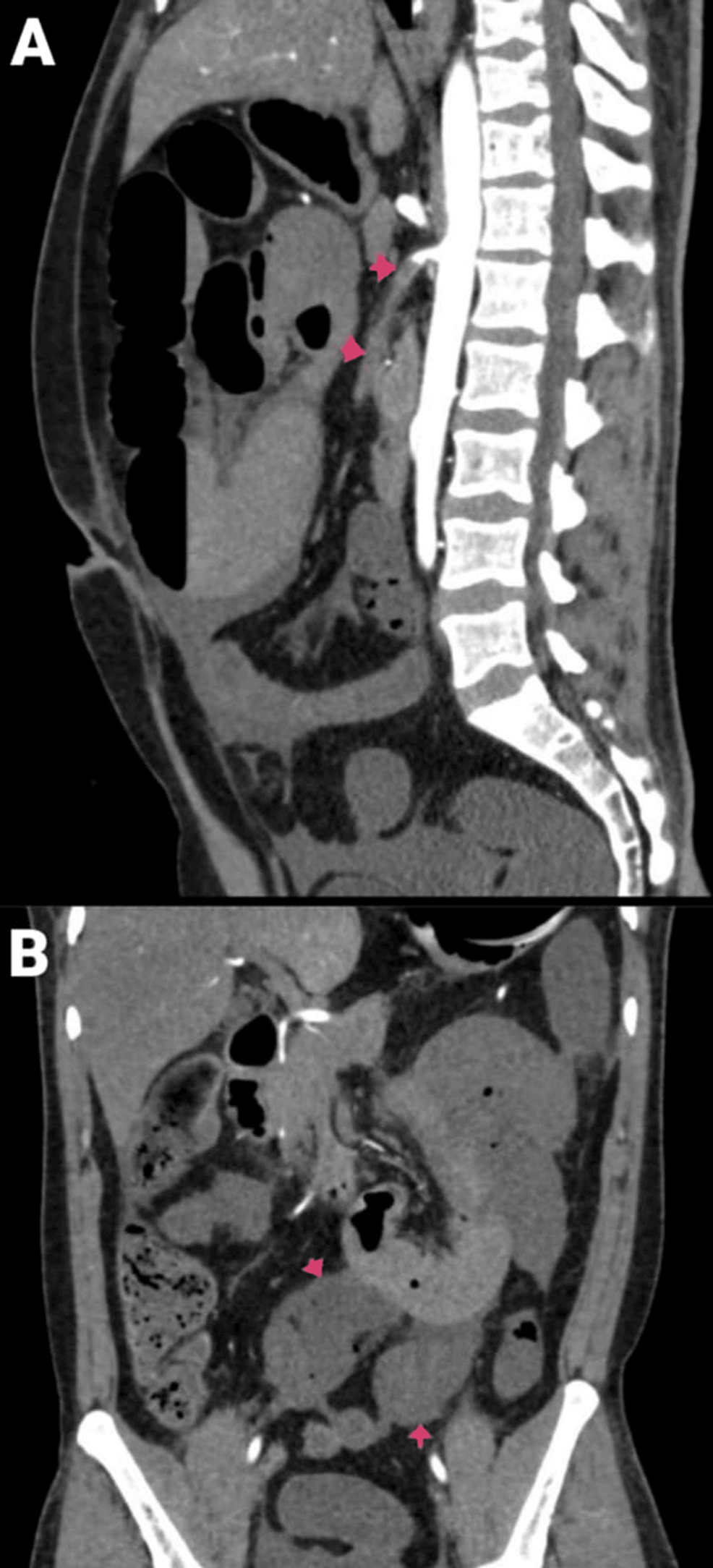 CECT-of-the-abdomen-and-pelvis-with-angiography-of-the-patient:-(A)-sagittal-section-and-(B)-coronal-section.