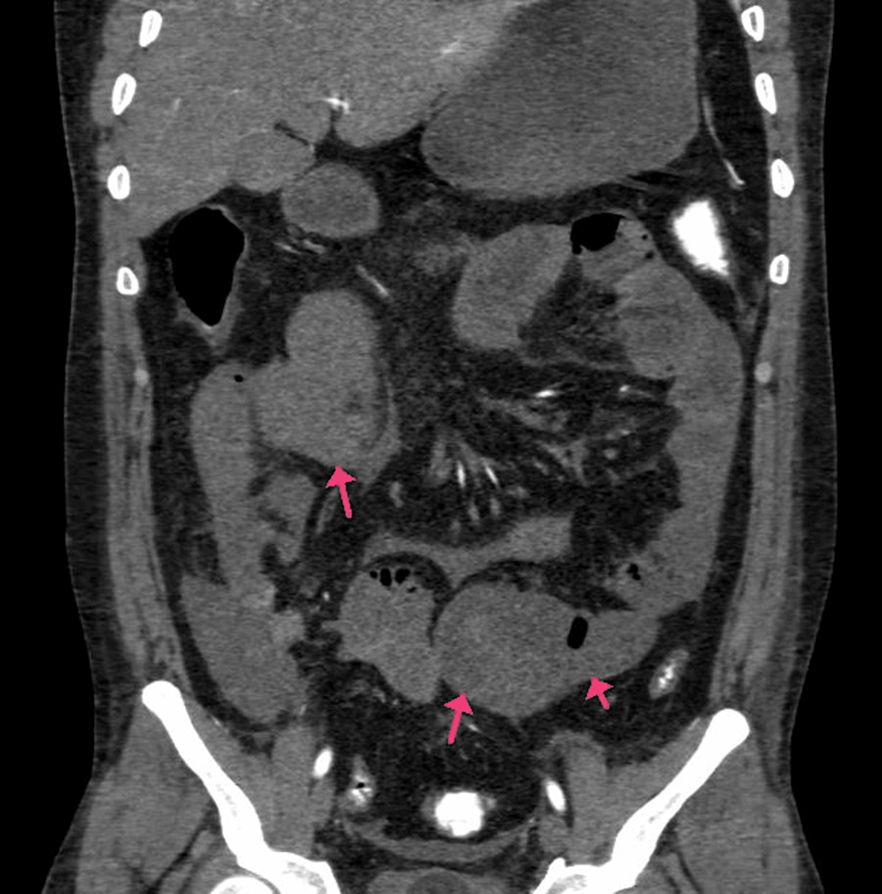 CECT-of-the-abdomen-and-pelvis-with-angiography-of-the-patient-(arrows-mild-hypo-enhancement-of-the-walls-with-a-mildly-dilated-caliber-of-ileal-loops-and-pneumatosis).