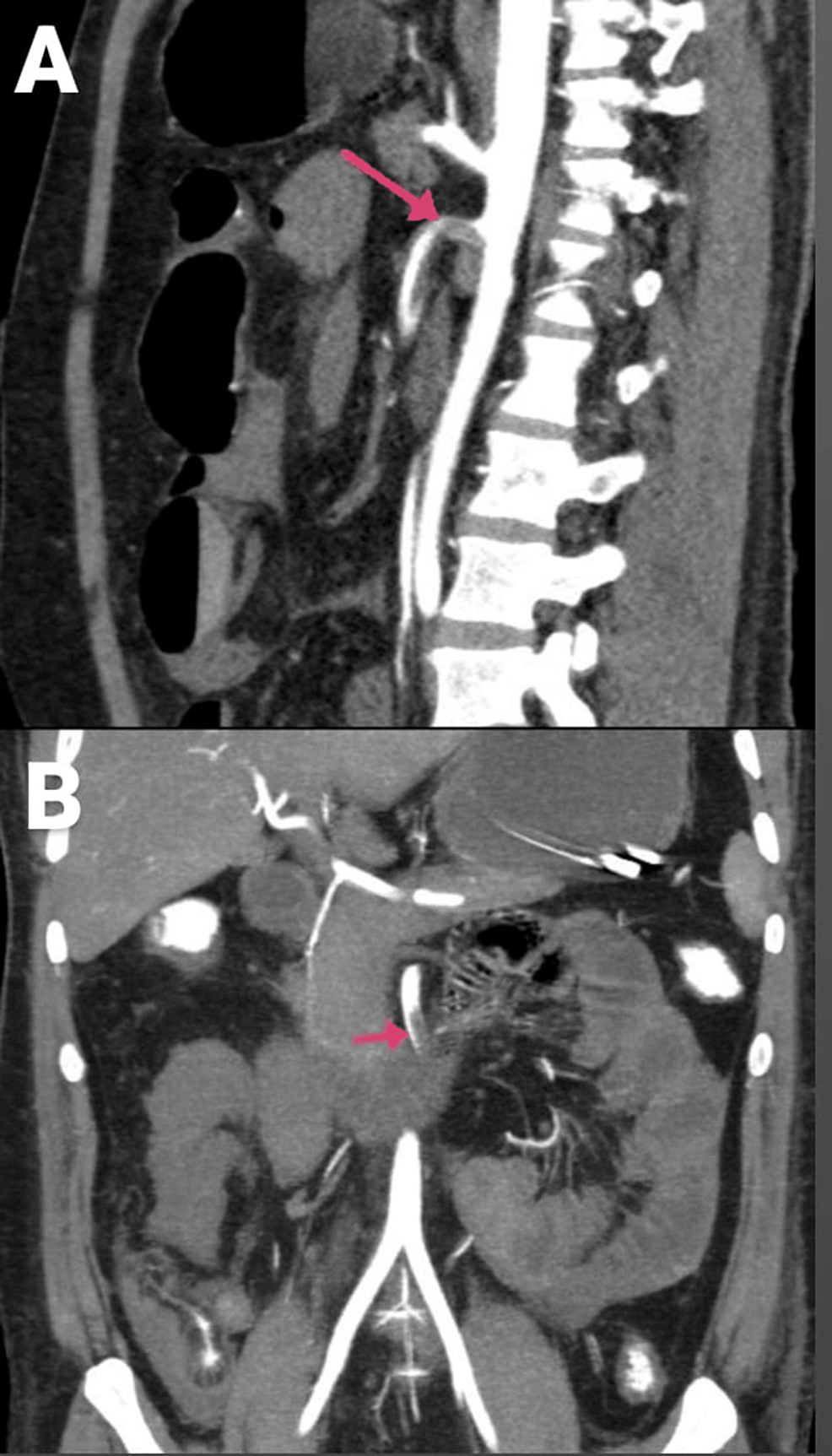 CECT-of-the-abdomen-and-pelvis-with-angiography-of-the-patient:-(A)-sagittal-section-and-(B)-coronal-section-(arrows-showing-the-SMA-thrombosis)