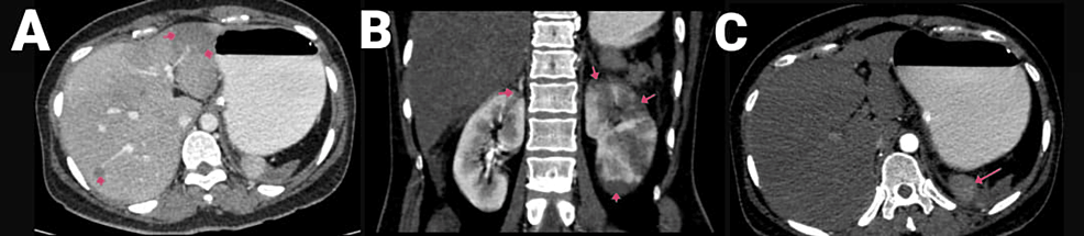 CECT-of-the-abdomen-and-pelvis-with-angiography-of-the-patient,-with-arrows-showing-(A)-hepatic-infarcts,-(B)-renal-infarcts,-and-(C)-shrunken-spleen-with-splenic-infarct.-