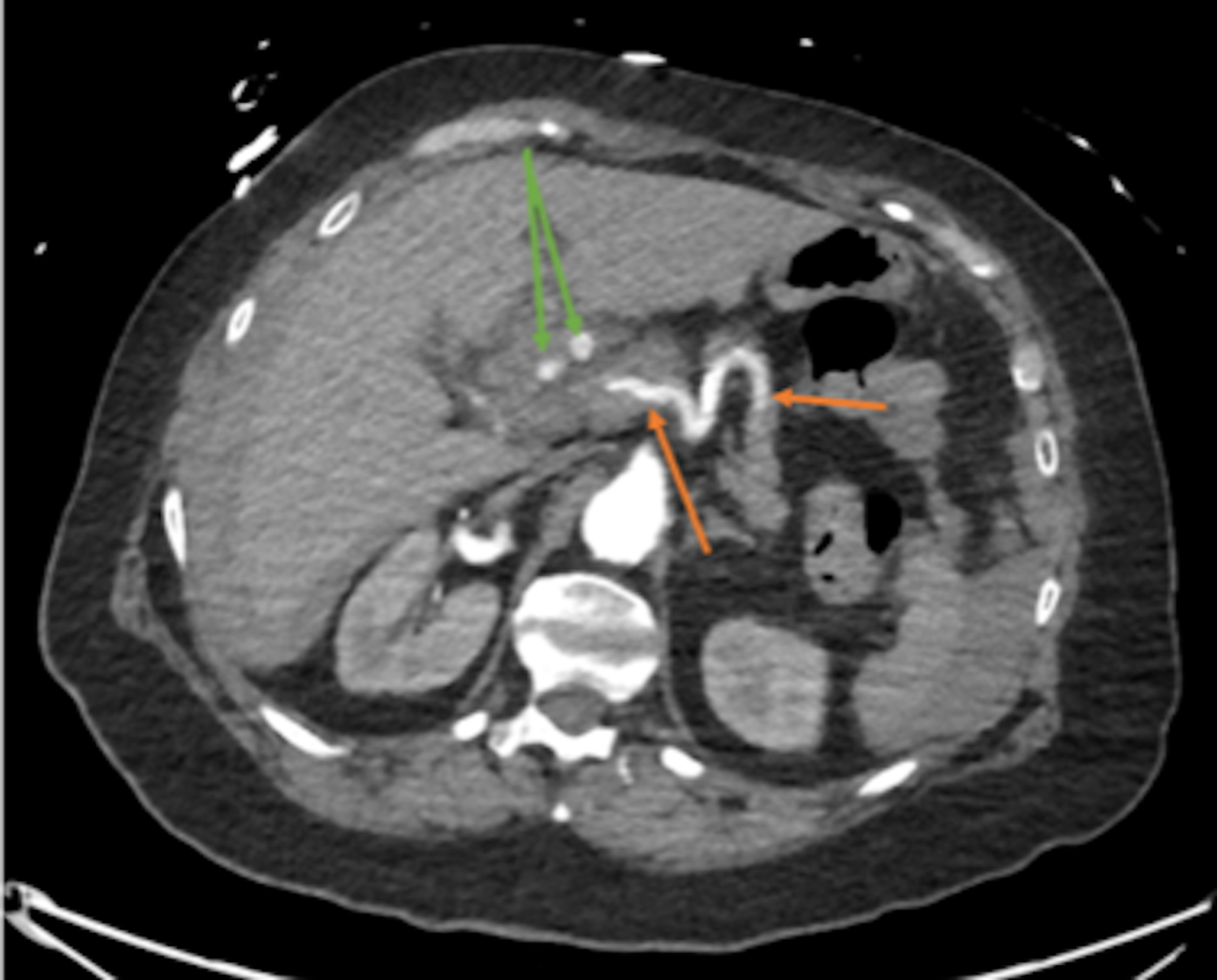 Cureus | Ruptured Hepatic Artery Aneurysm
