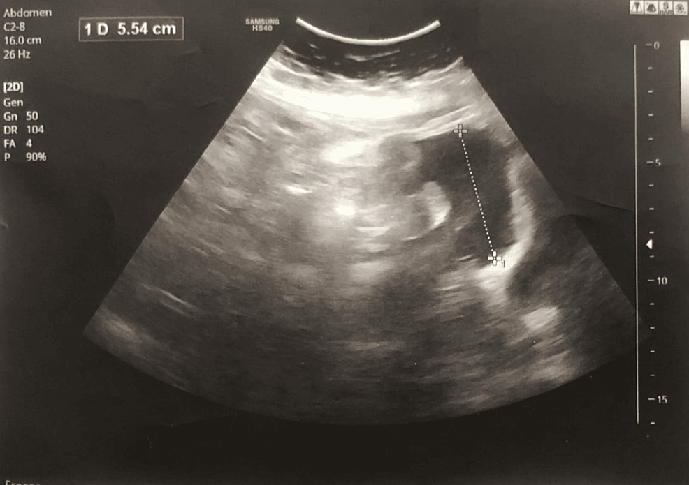 Abdominal-ultrasonography