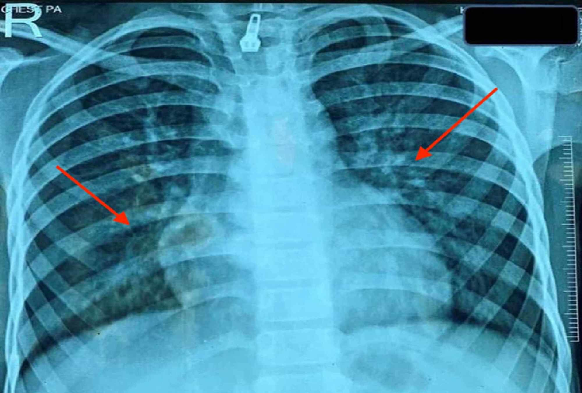 Cureus Pulmonary Hemosiderosis in a Child With Systemic Lupus