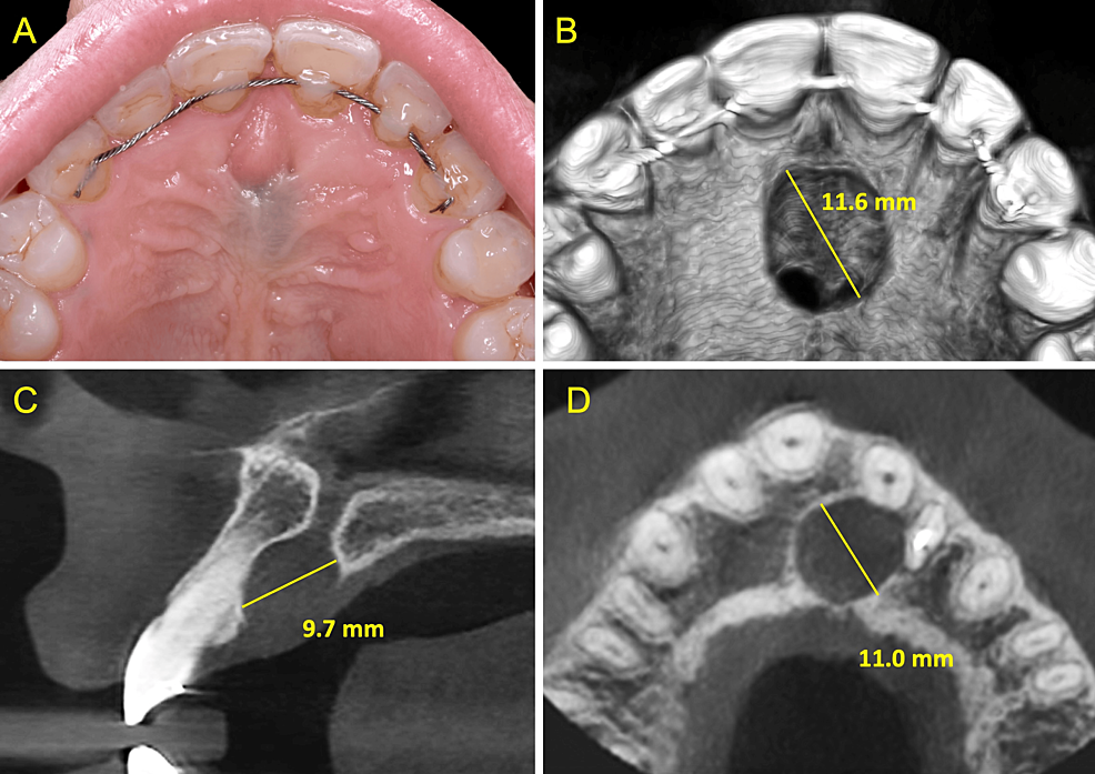 Cureus A Novel ZincContaining Palatal Stent and Topical Oxygen