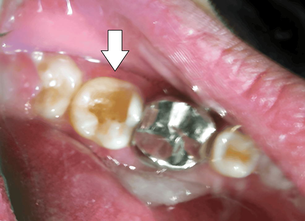 PinRetained Amalgam An Intricate Restorative Case Study Cureus