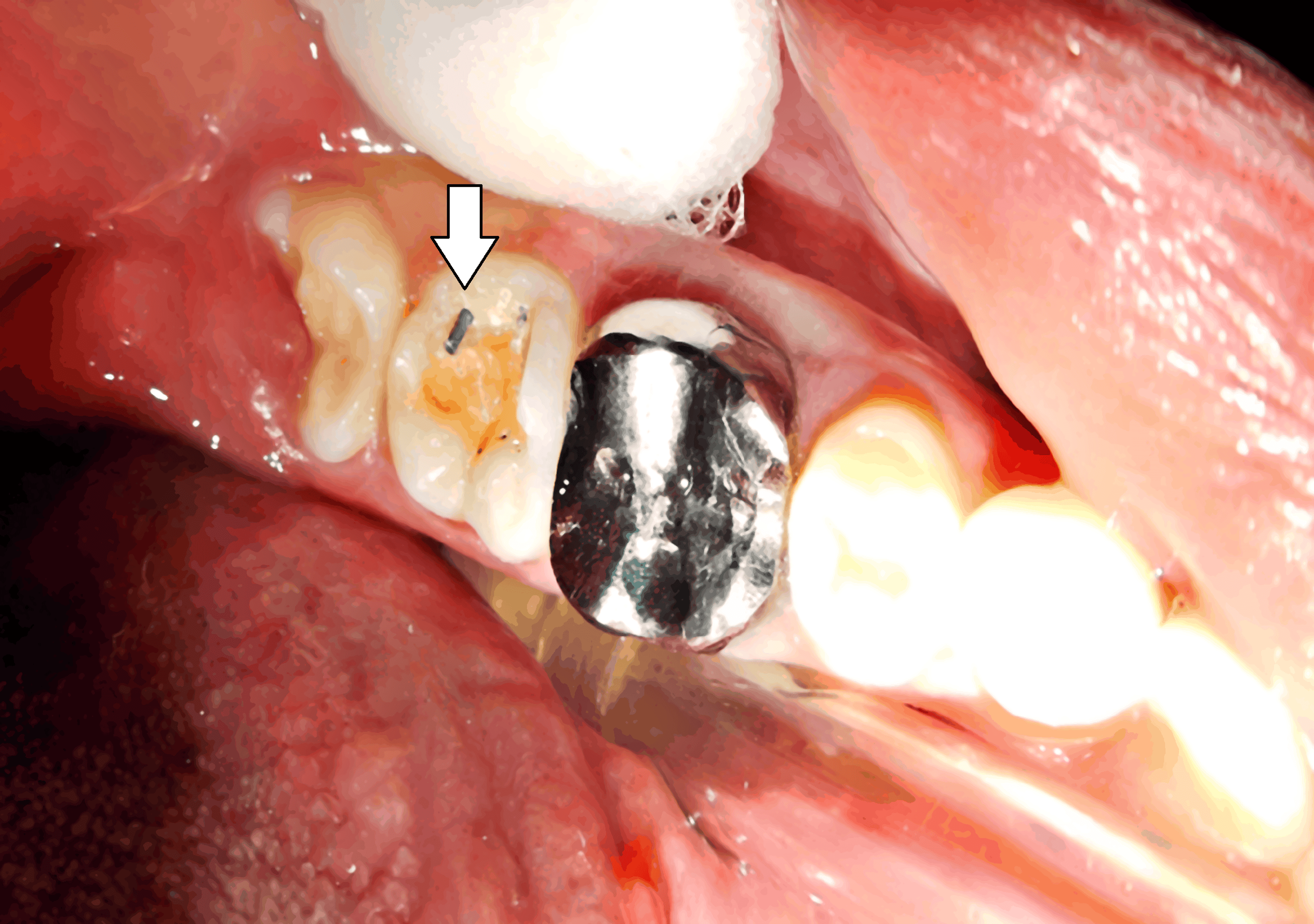PinRetained Amalgam An Intricate Restorative Case Study Cureus