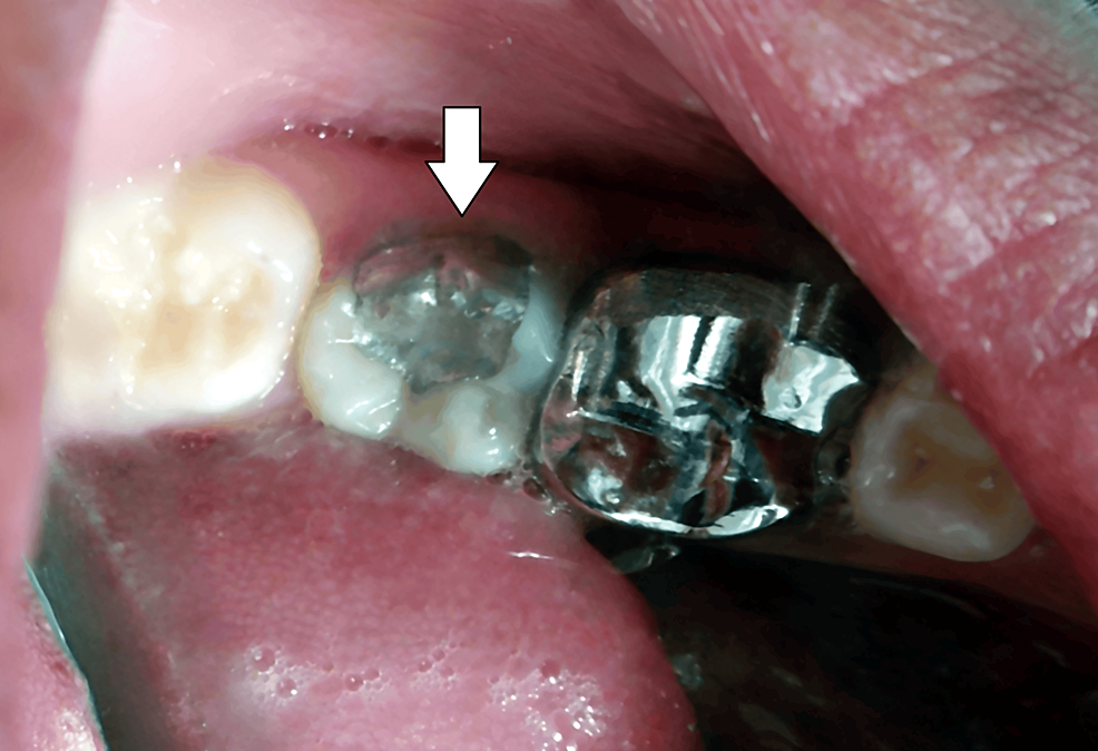 PinRetained Amalgam An Intricate Restorative Case Study Cureus