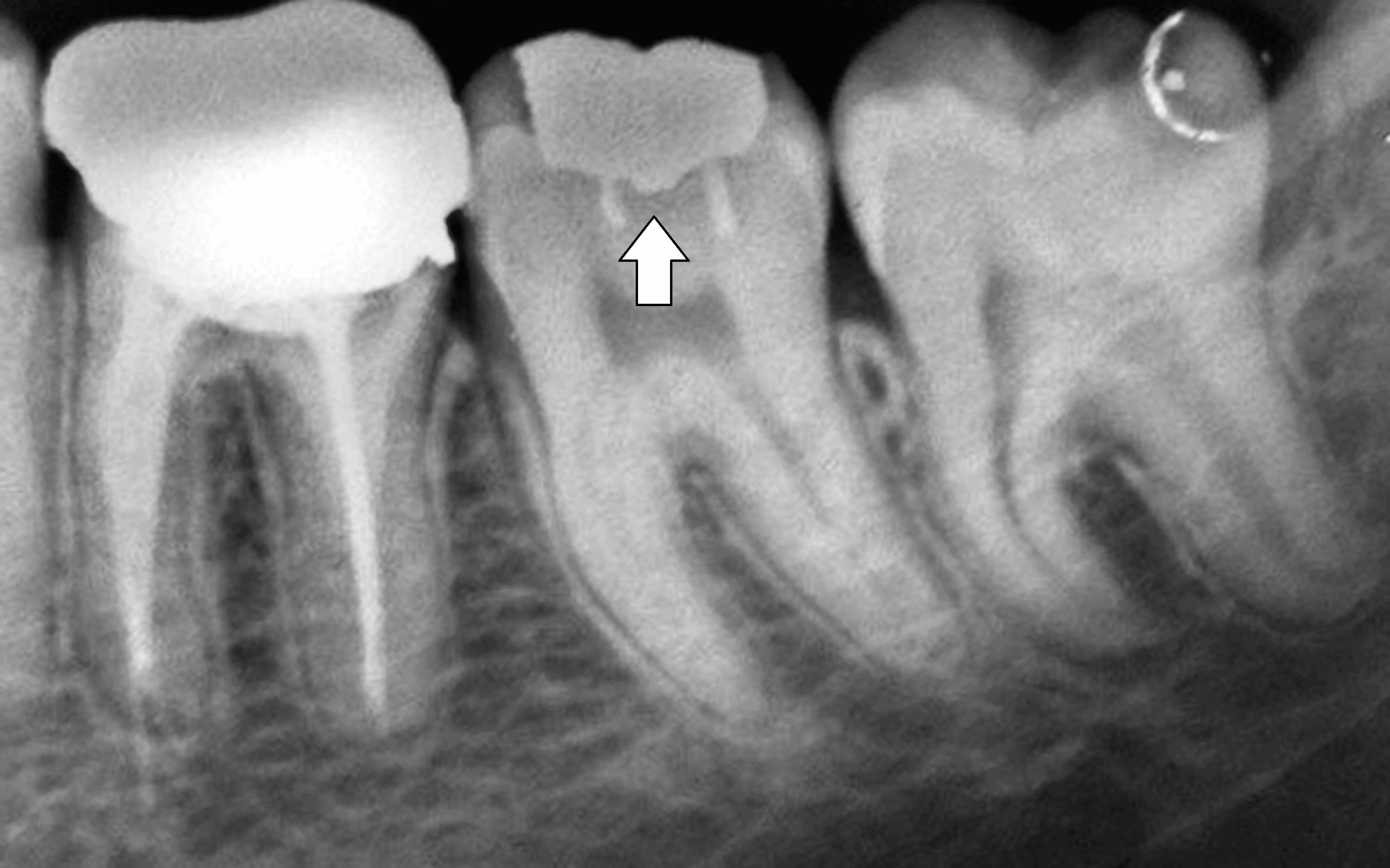 PinRetained Amalgam An Intricate Restorative Case Study Cureus