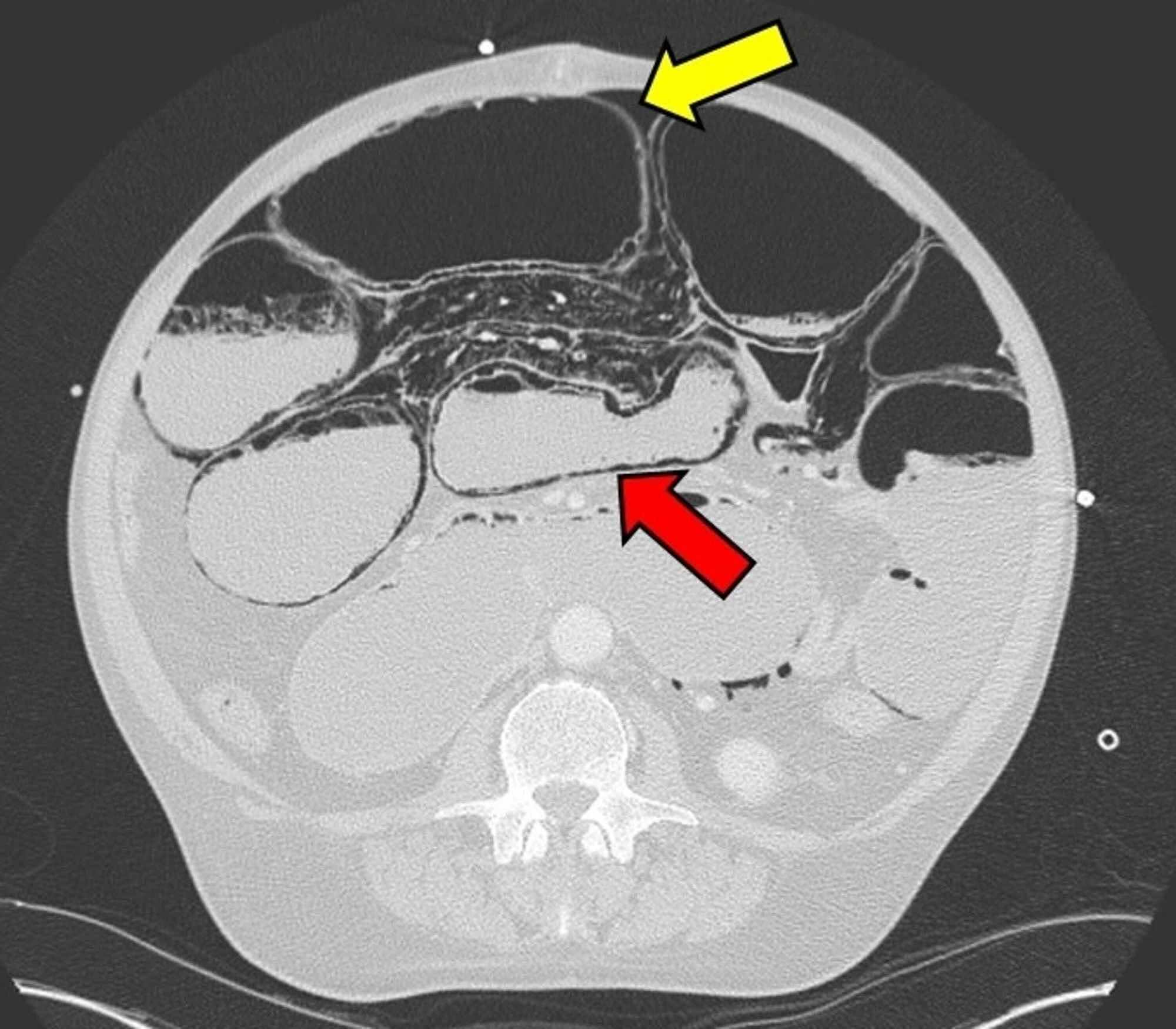 Cureus A Rare Case Of Chronic Small Bowel Pseudo Obstruction | Free Hot ...