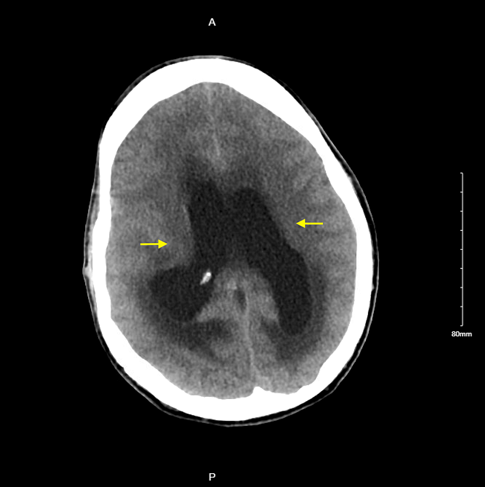 Cryptococcal Meningitis in an Immunocompetent Patient With Underlying Risk  Factors | Cureus