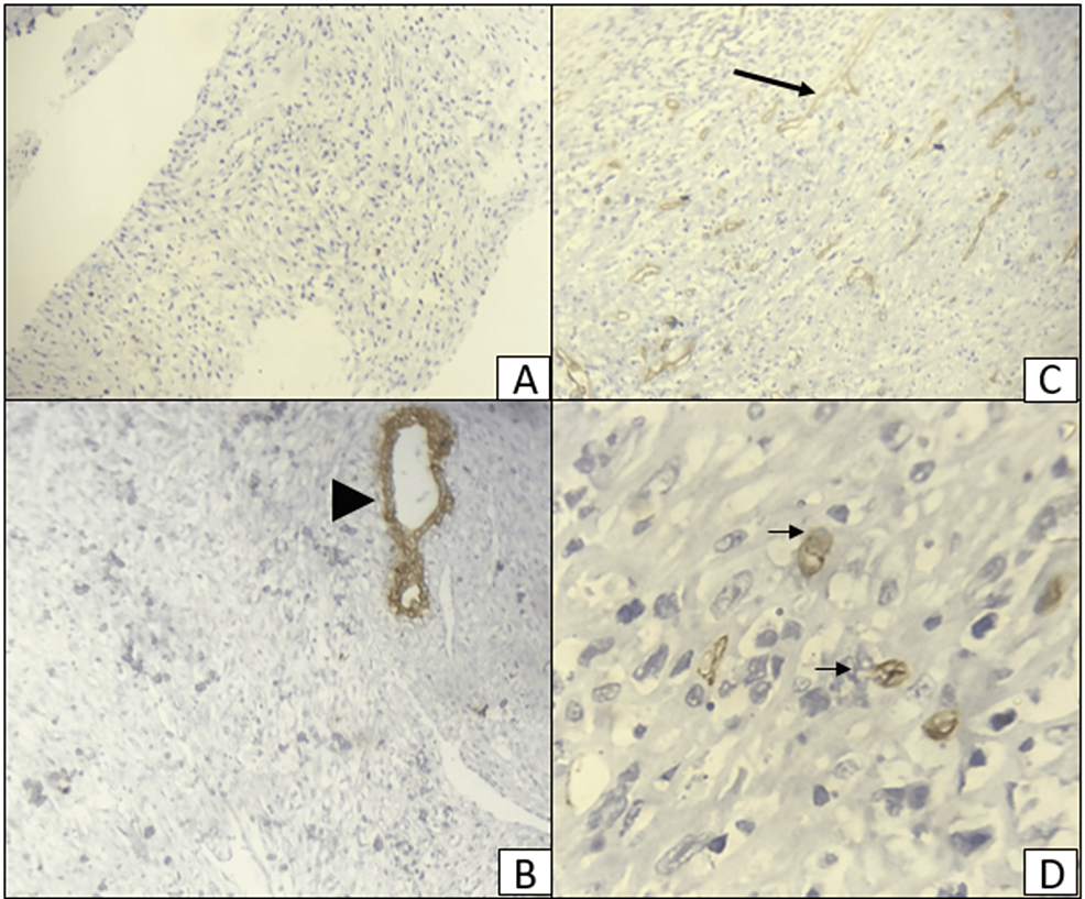 An-immunohistochemical-(IHC)-stained-section-of-the-breast-mass-showing-negative-expression-of-the-cytokeratin-(CK)-(A-and-B)-and-focal-positive-expression-(black-arrows)-of-CD34-(C-and-D).-A-and-C:-×100,-B-and-D:-×400.