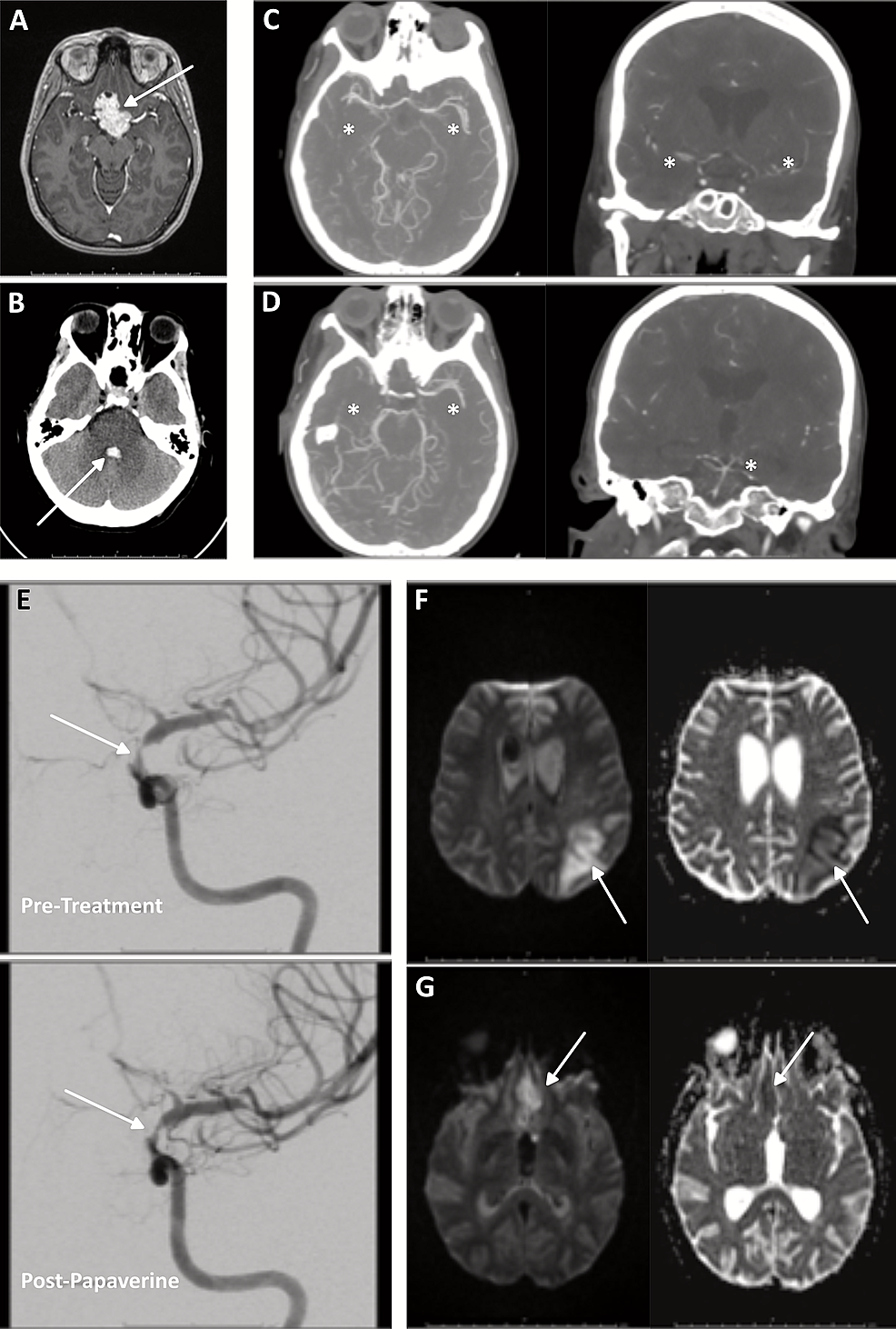 Cureus, Brainstem and Spinal Arachnoiditis Ossificans Associated With  Neurocysticercosis: A Case Report