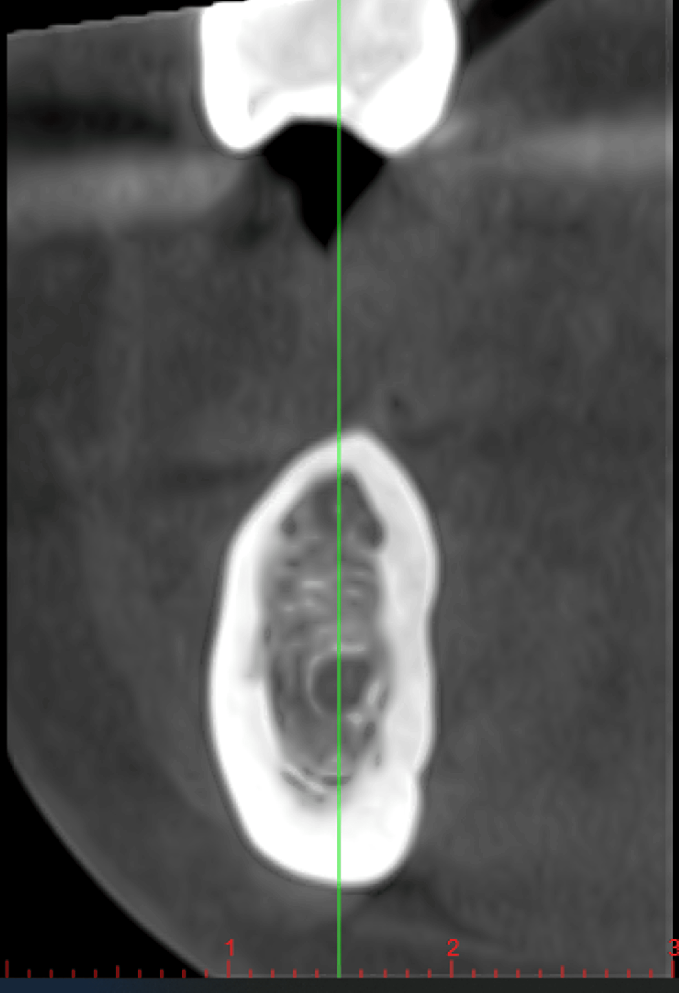 Effect of Photobiomodulation on Crestal Bone Density Around Dental