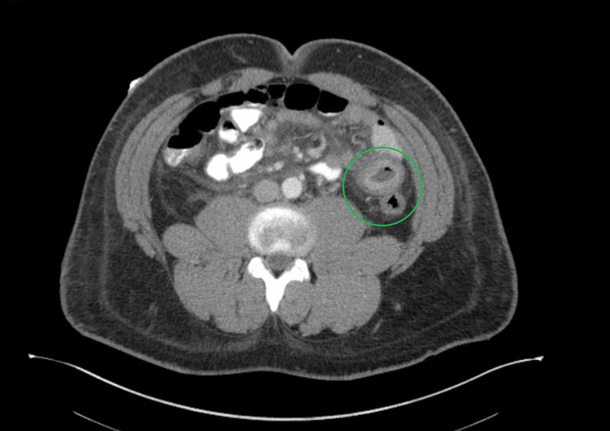 Cureus Targets and Combs A Case of Lupus Enteritis