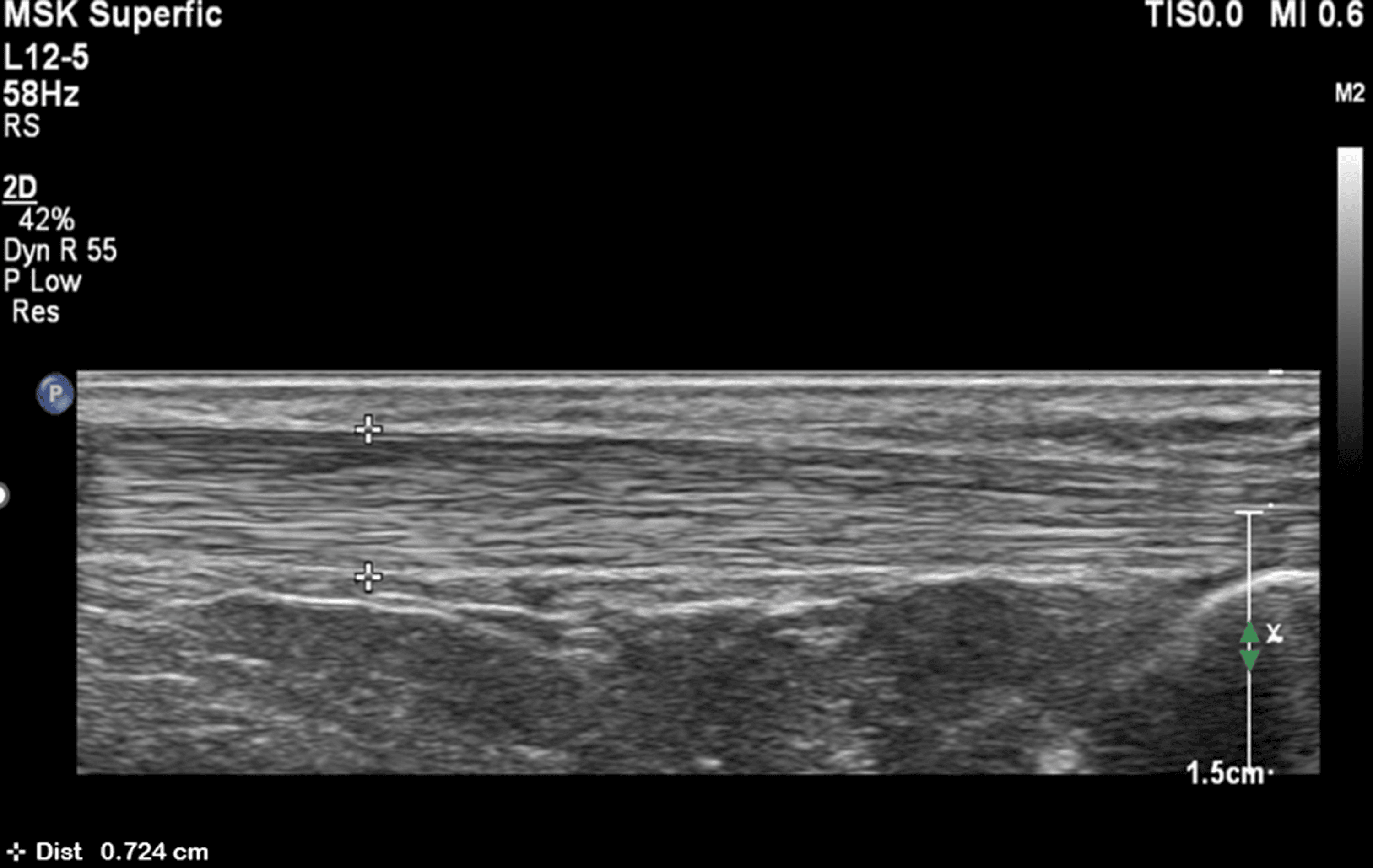 Ultrasound Evaluation Of Achilles Tendon Thickness In Diabetic Patients ...